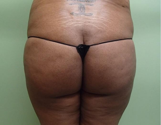 Auto Fat to Buttocks Before