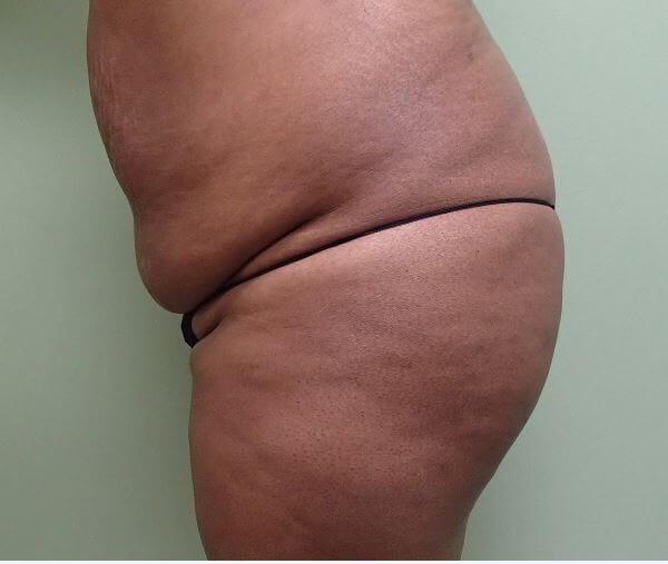 Auto Fat to Buttocks Before