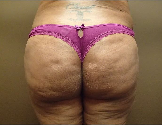 Auto Fat to Buttocks After