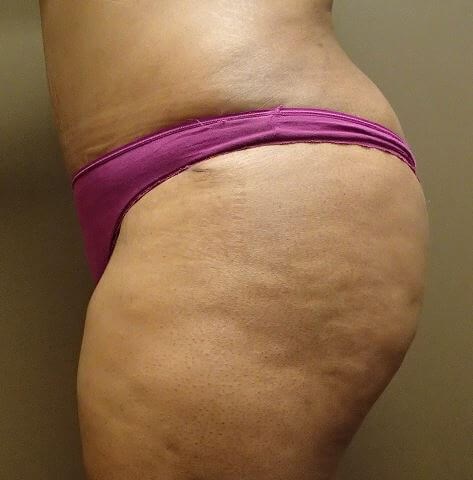 Auto Fat to Buttocks After