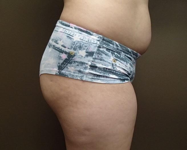 Auto Fat to Buttocks Before