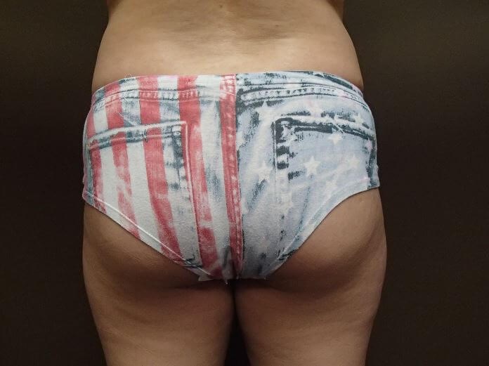 Auto Fat to Buttocks Before