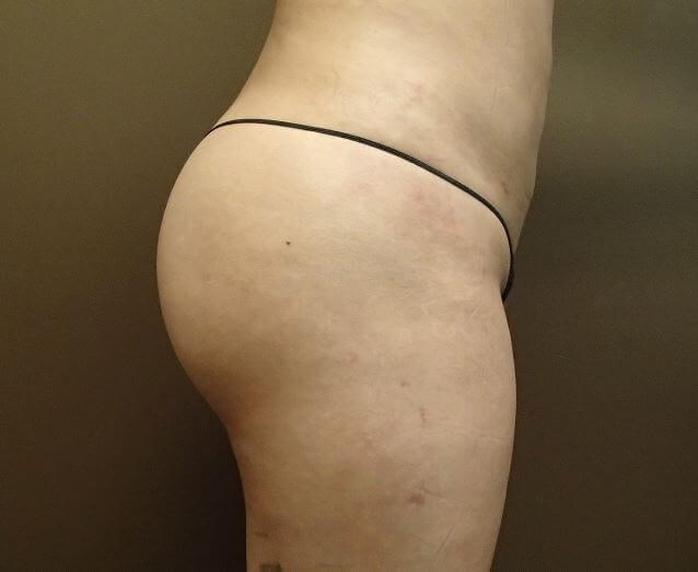 Auto Fat to Buttocks After