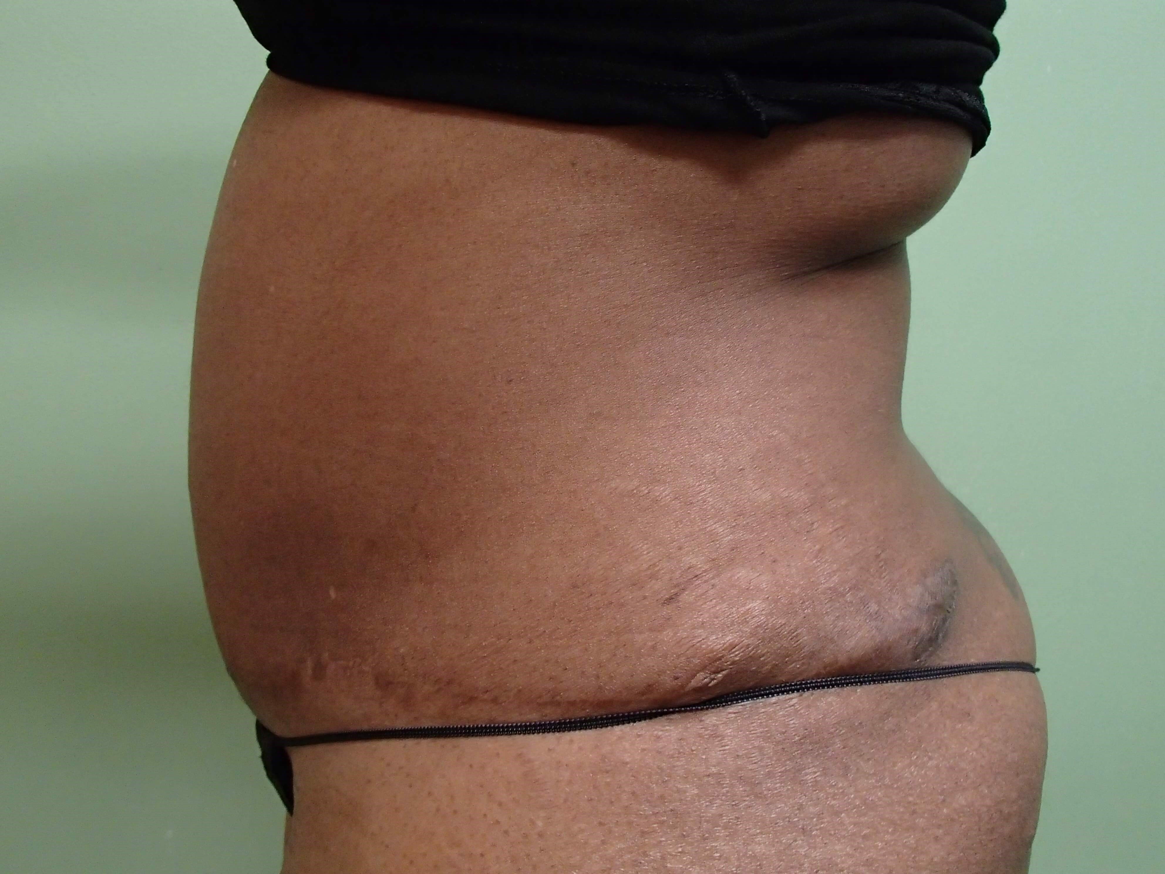 Liposuction Before