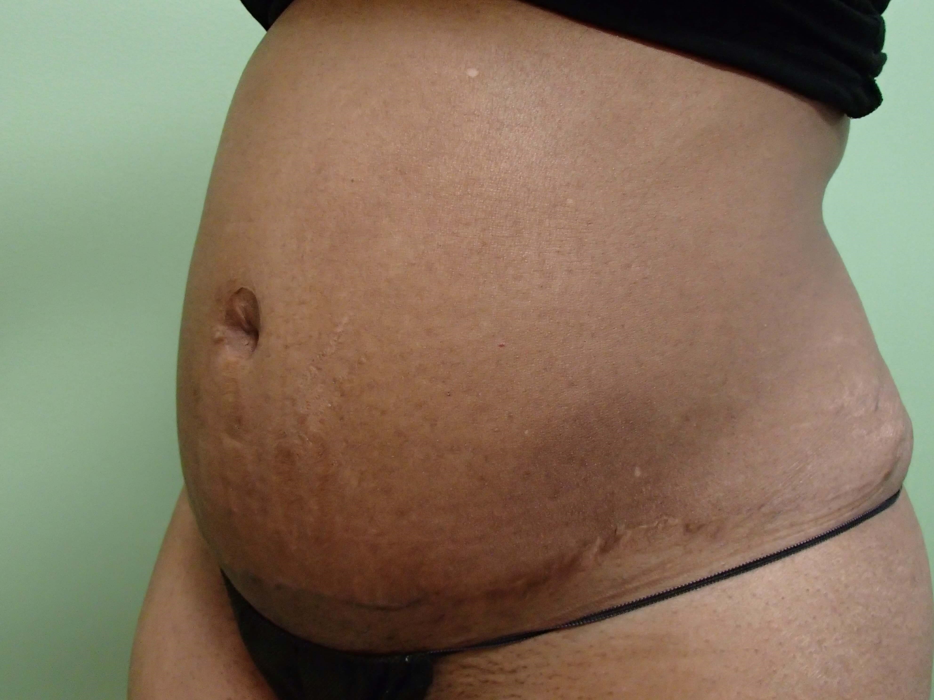 Liposuction Before
