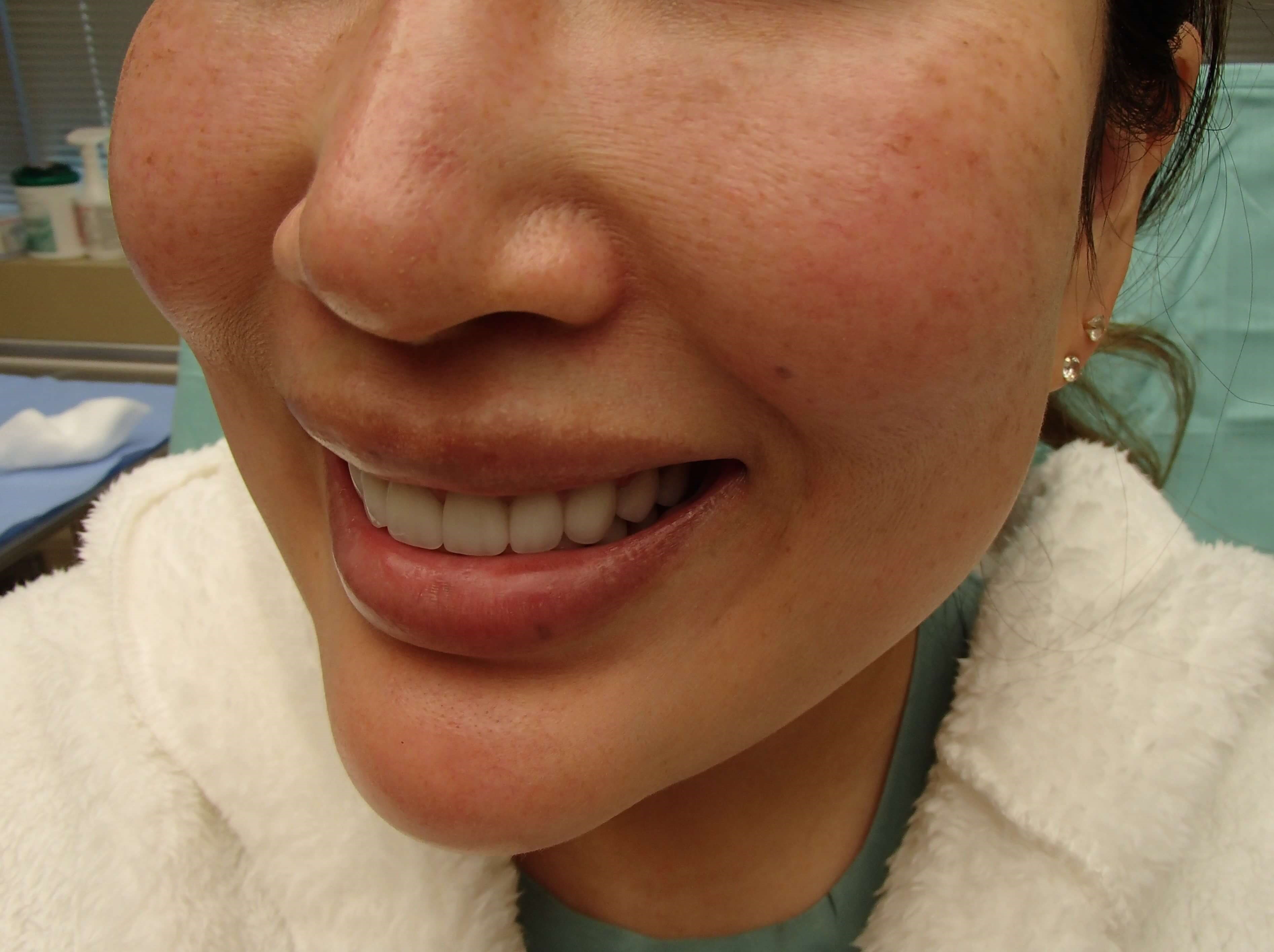 Dimpleplasty Before