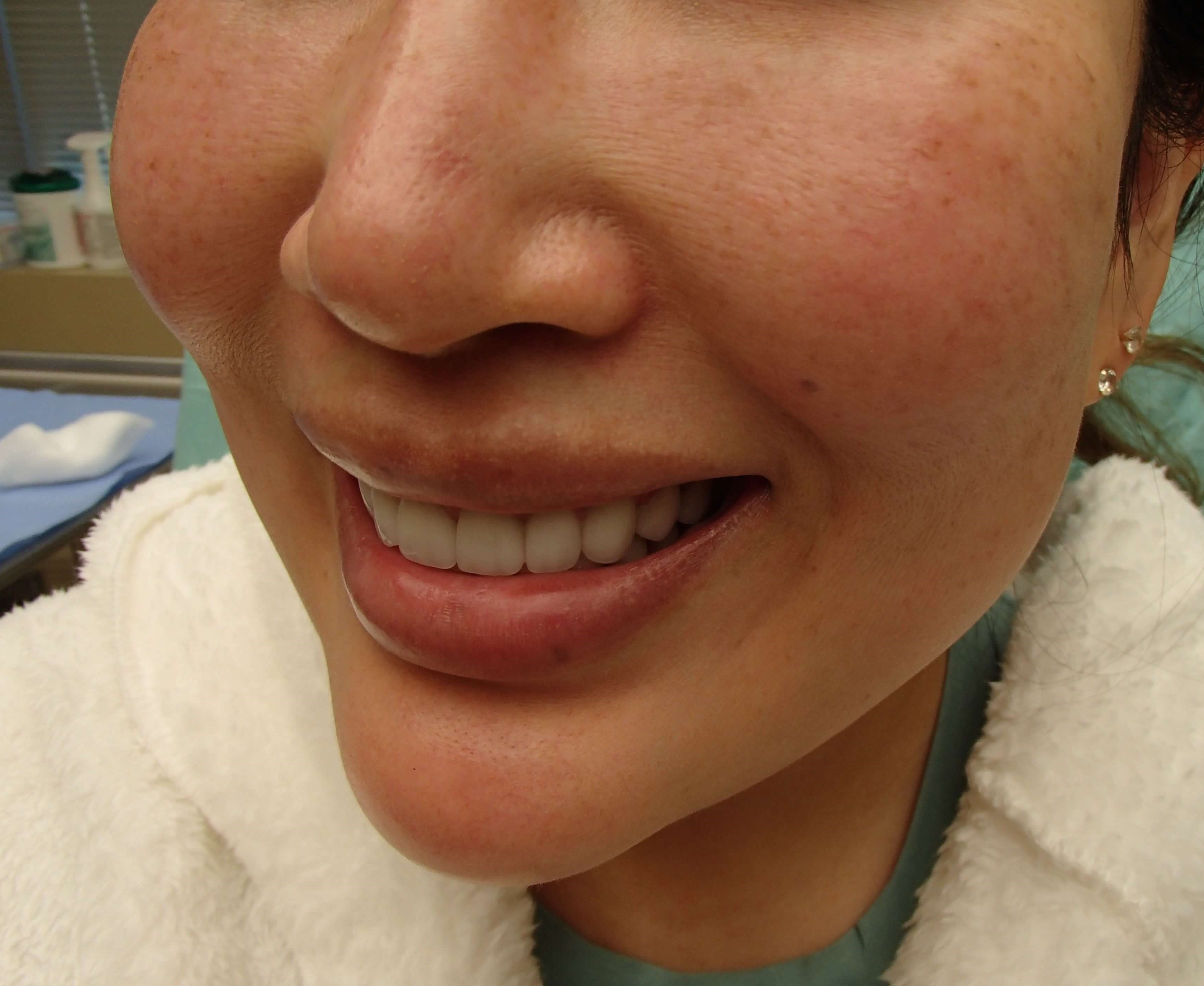 Dimpleplasty Before