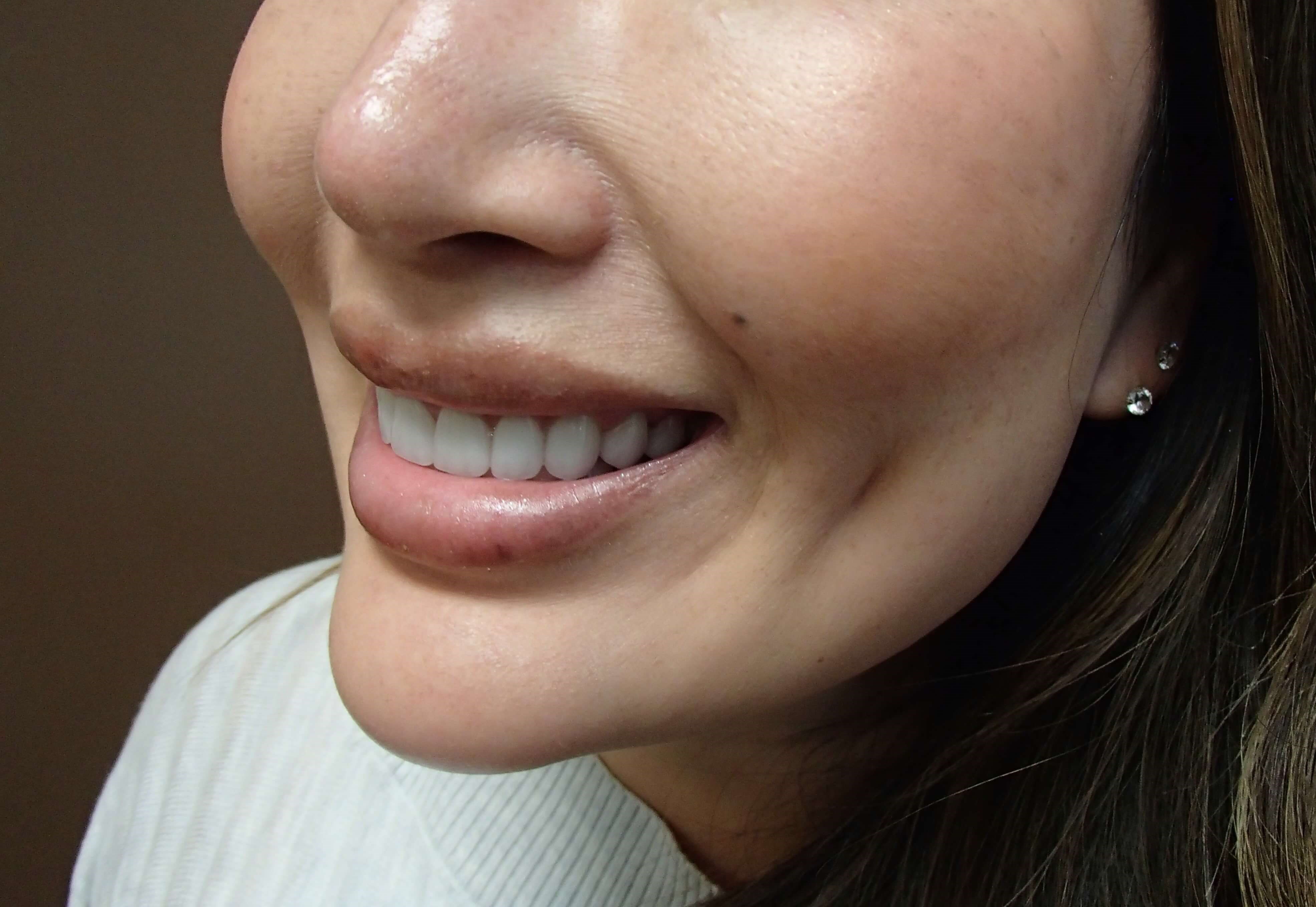 Dimpleplasty After