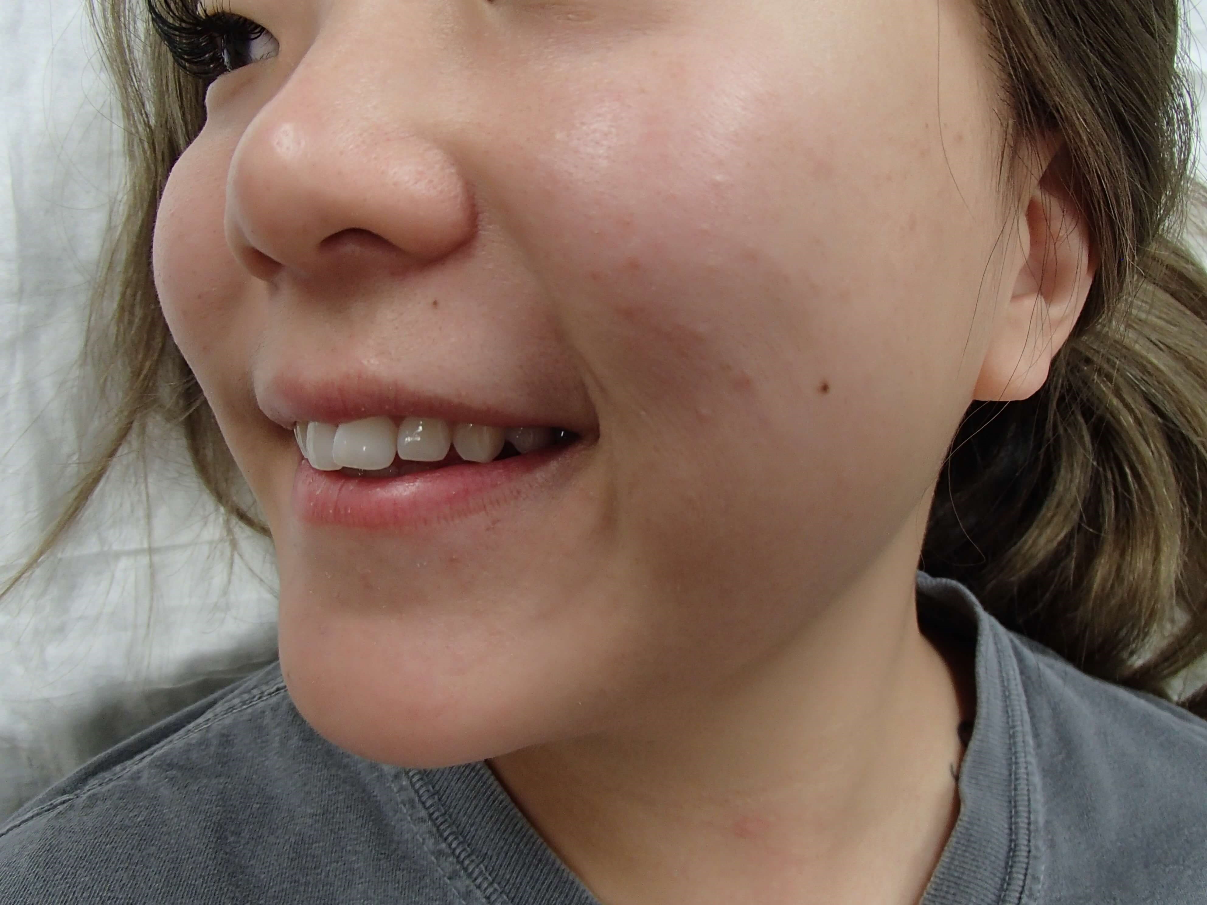 Dimpleplasty Before