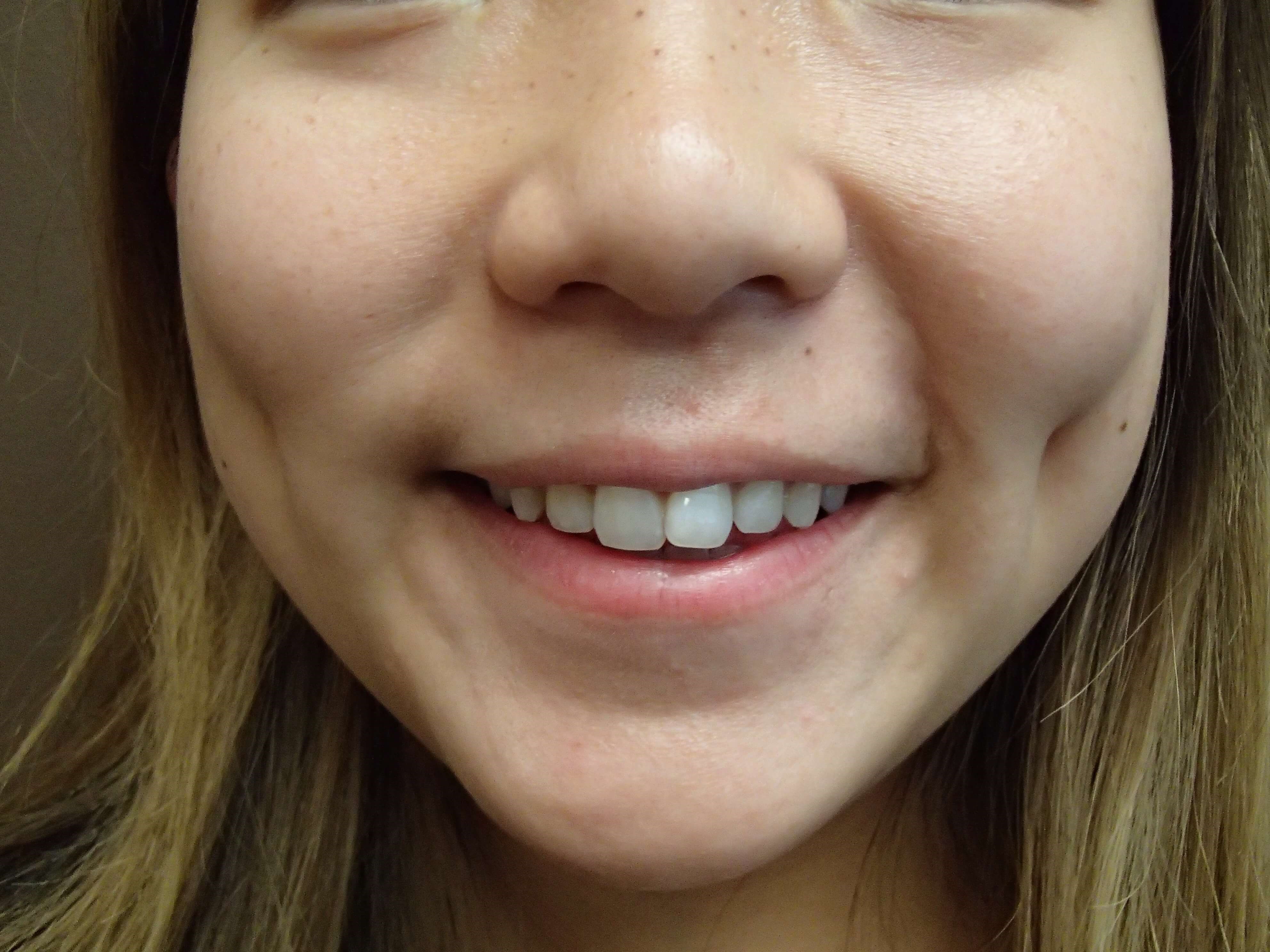 Dimpleplasty After