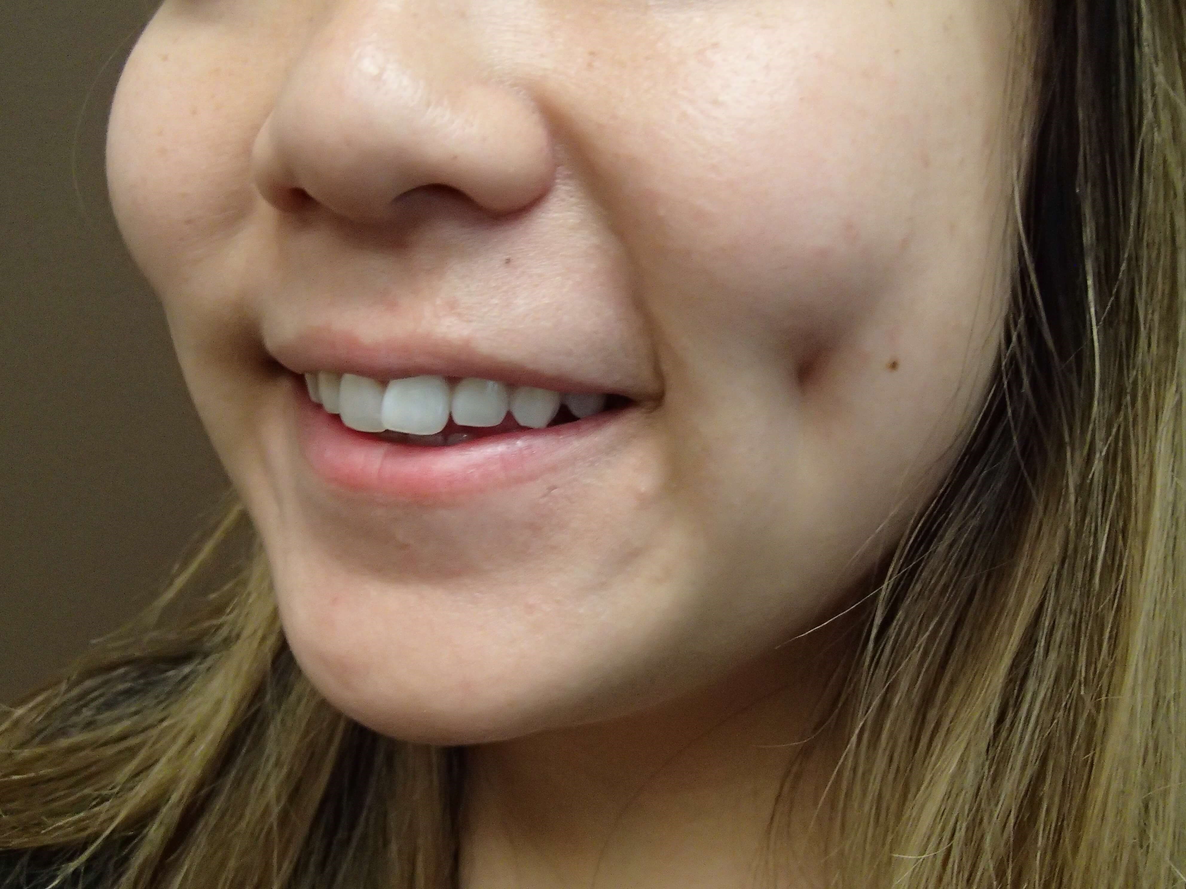 Dimpleplasty After