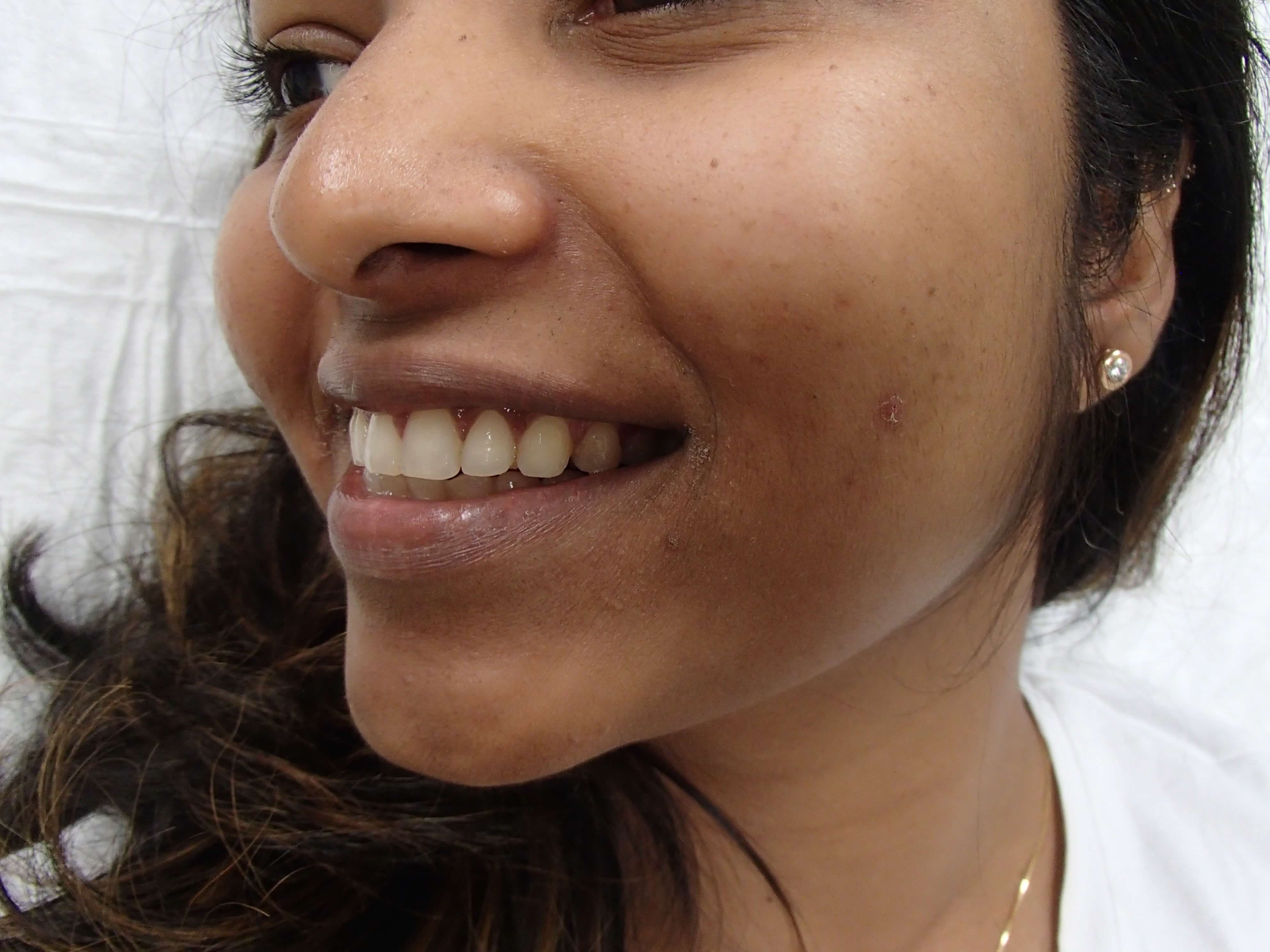Timeless Dimples Before