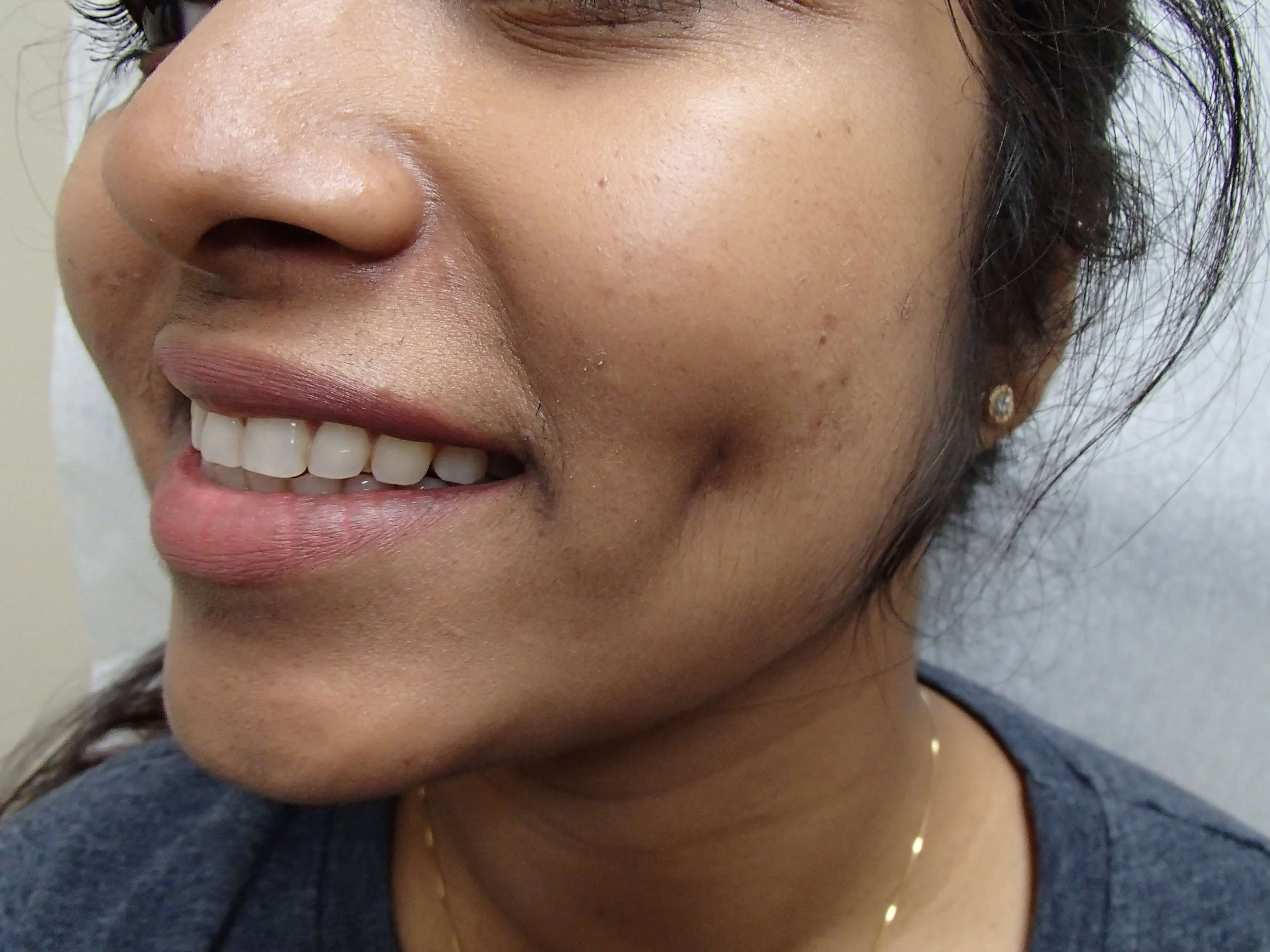 Timeless Dimples After