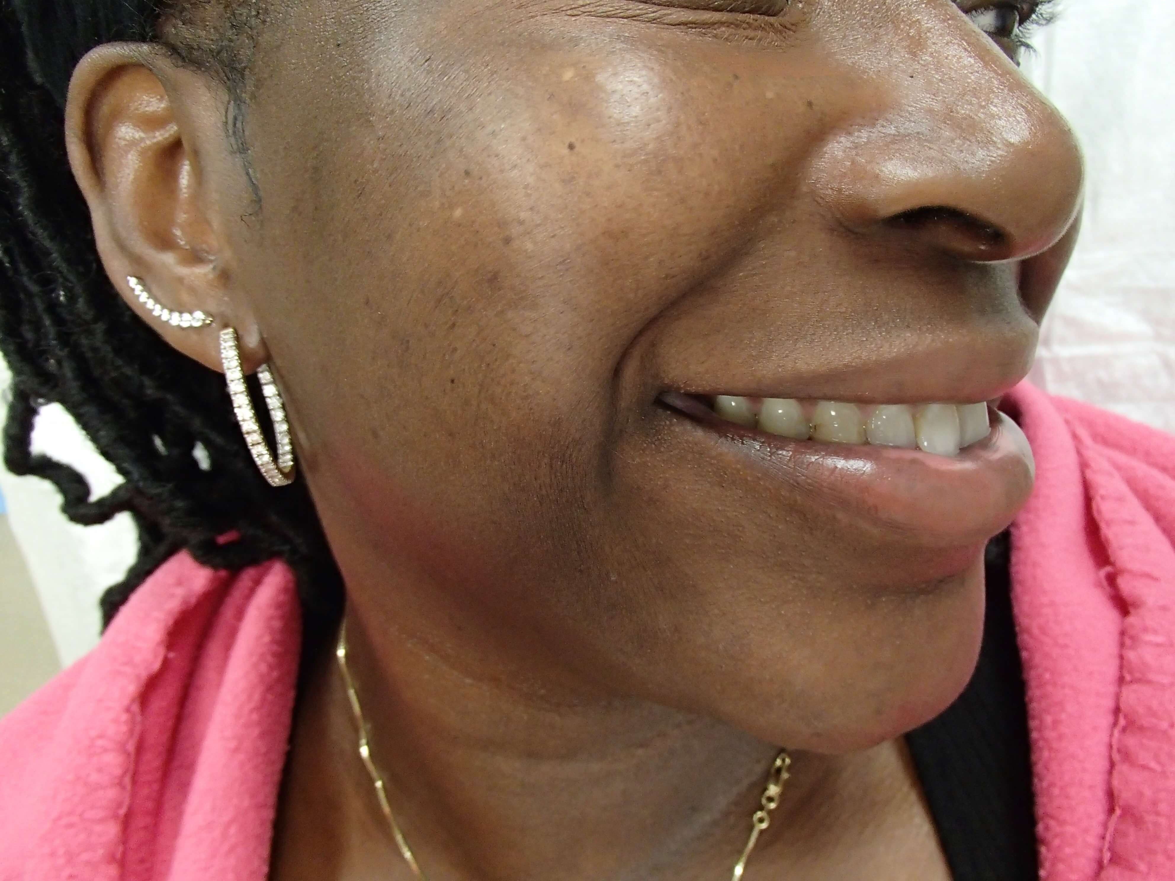 Timeless Dimple Before