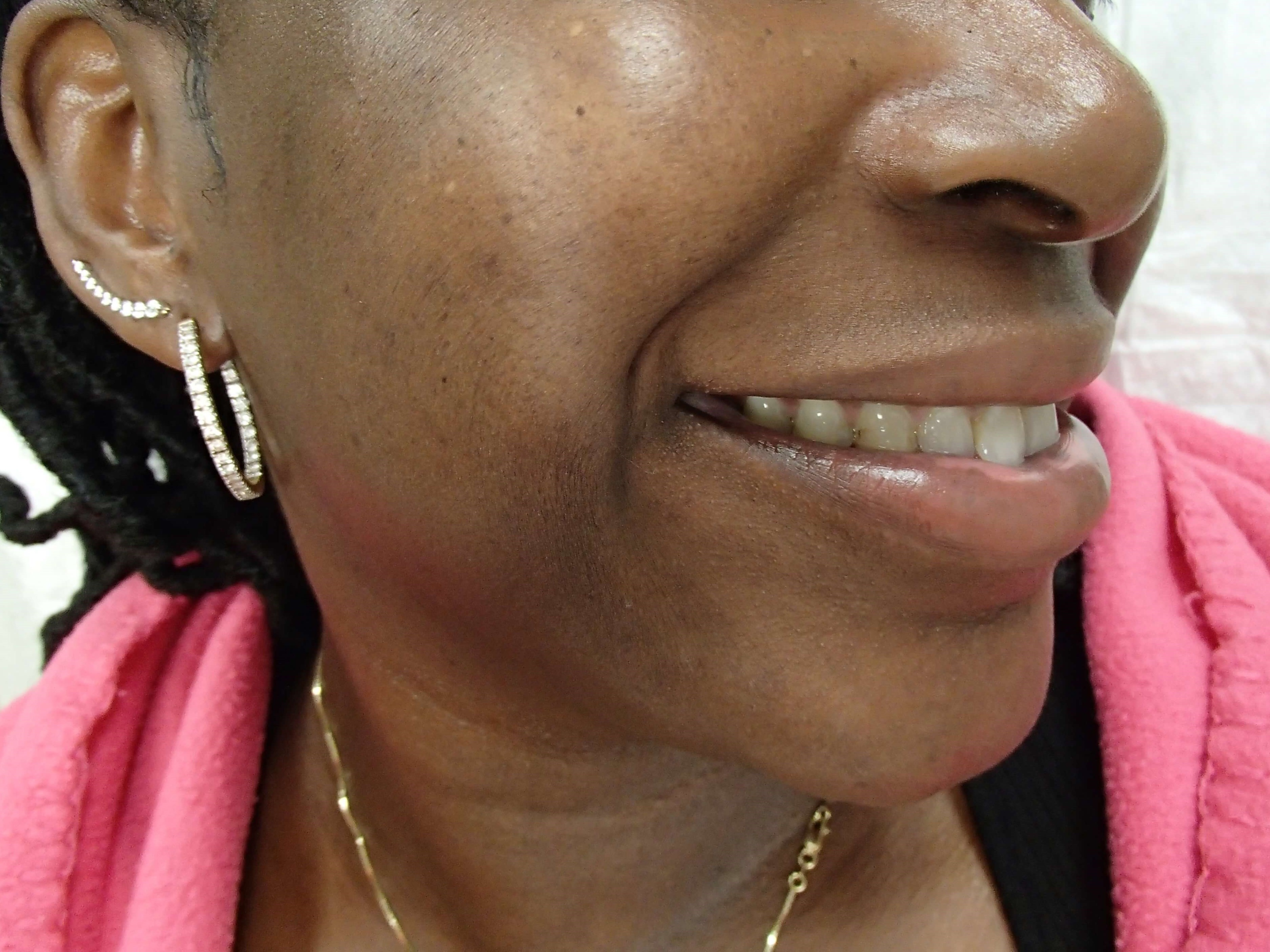 Timeless Dimple Before