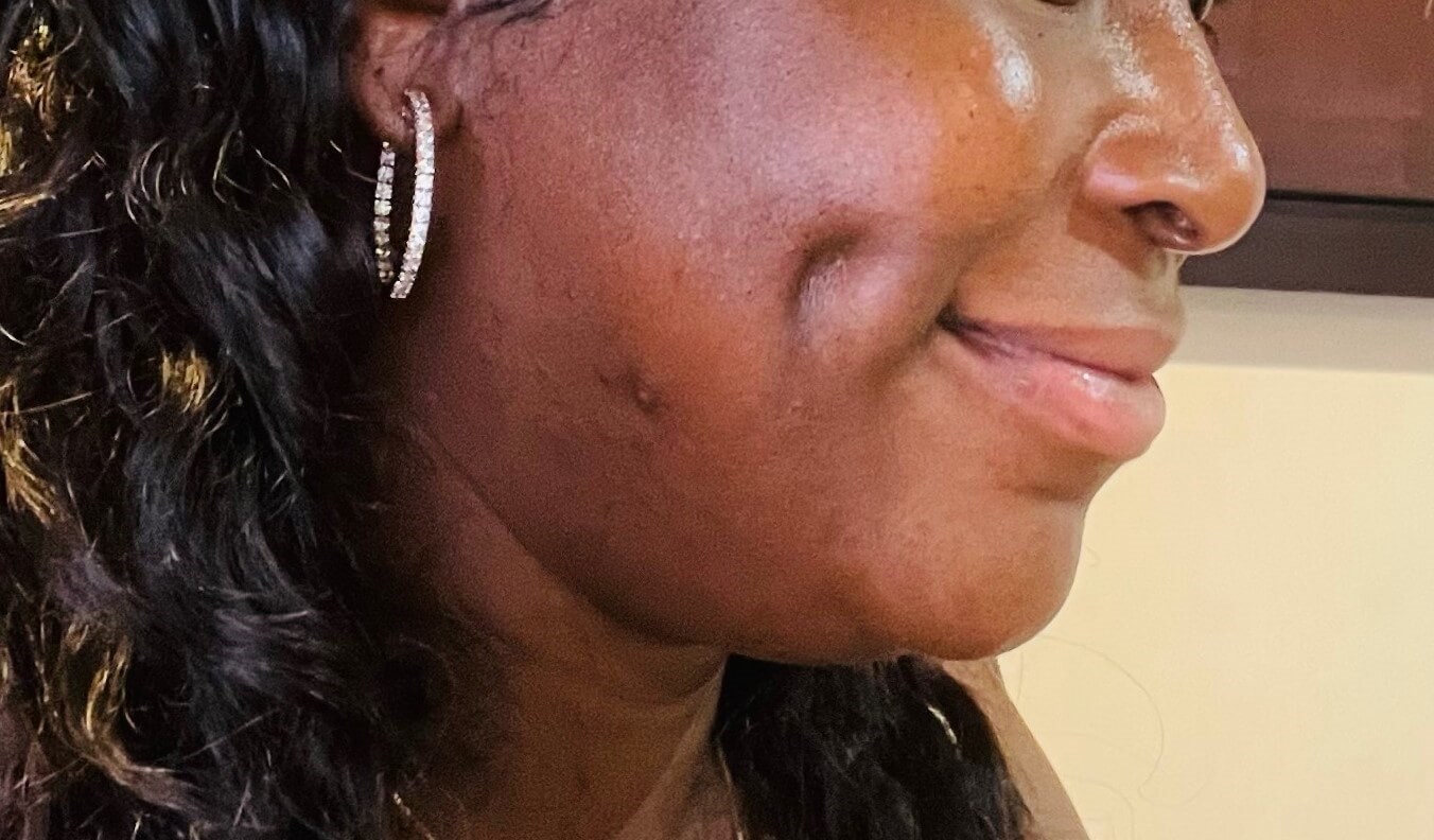Timeless Dimple After