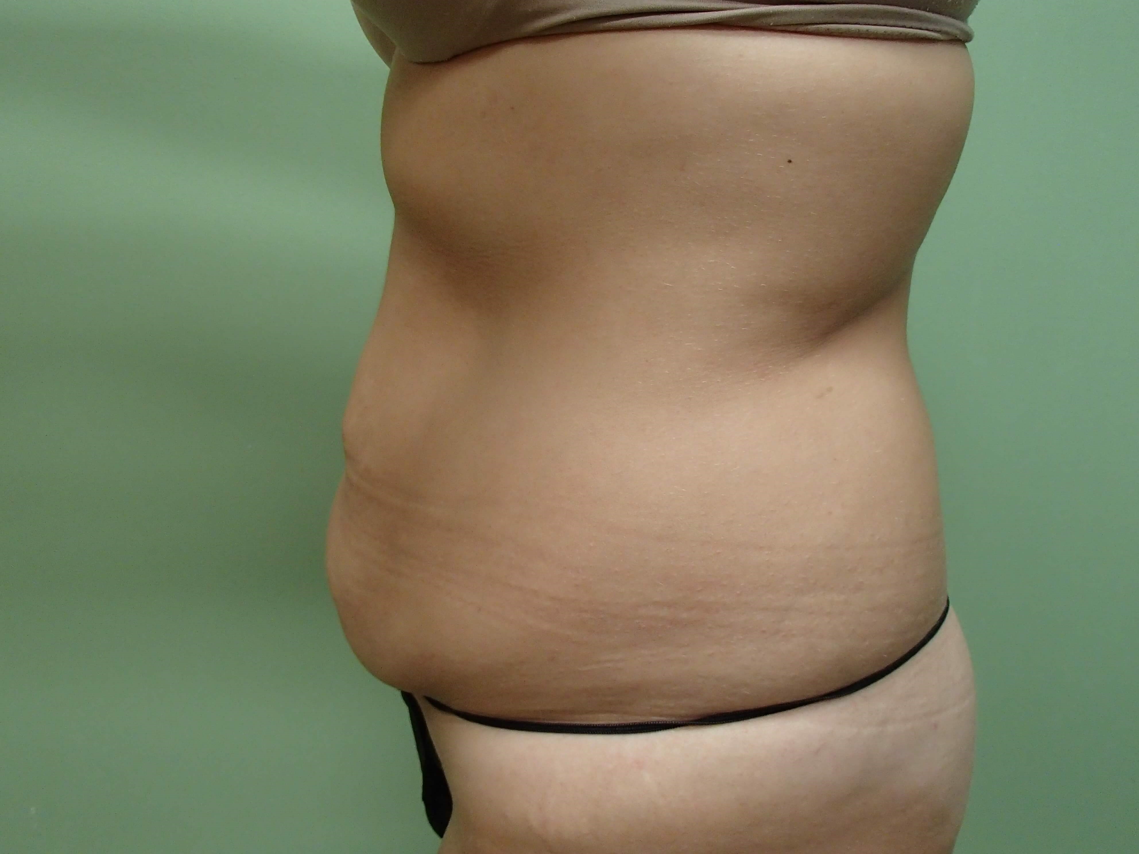 Timeless Tuck Before