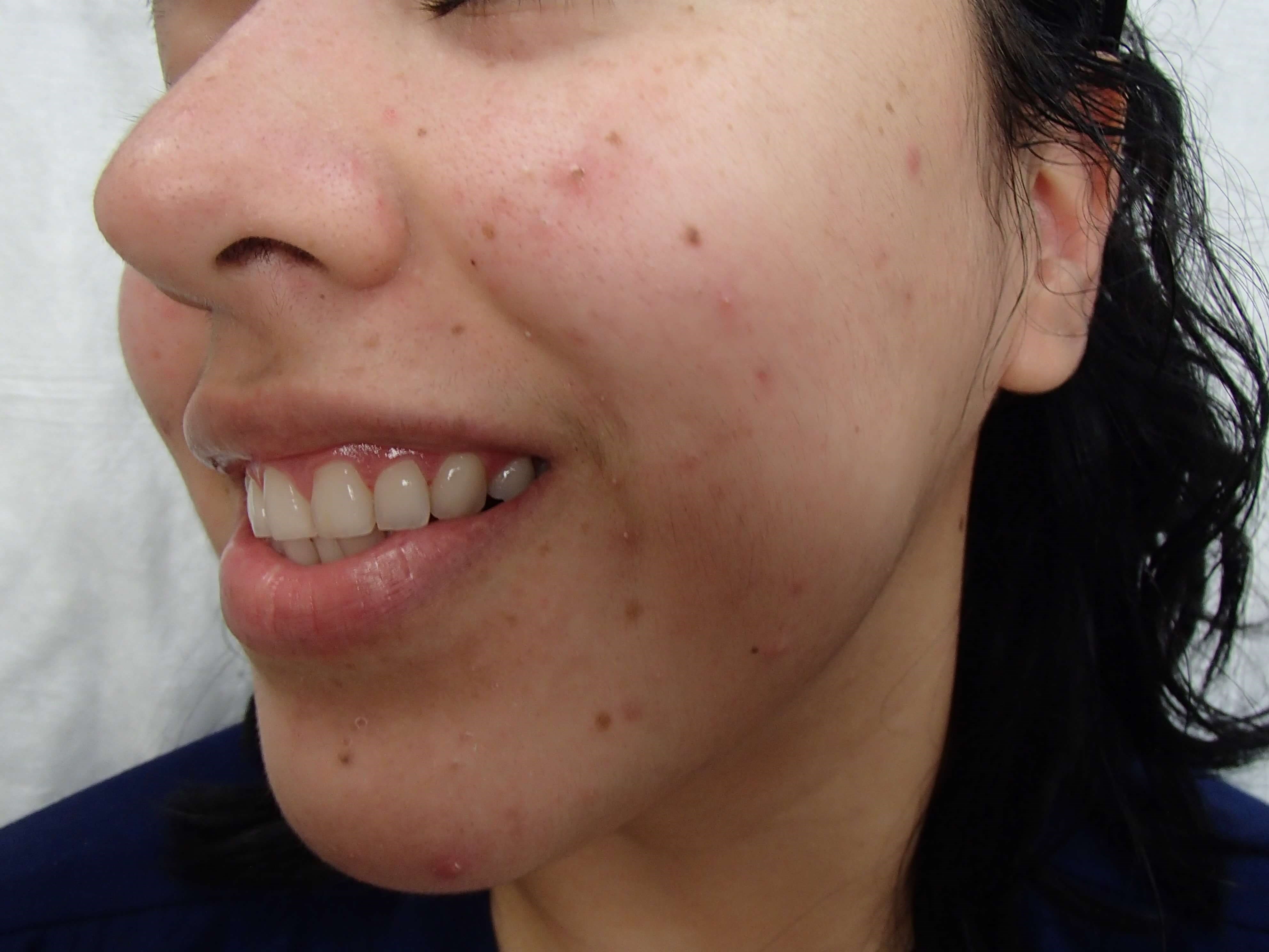 Timeless Dimple Before