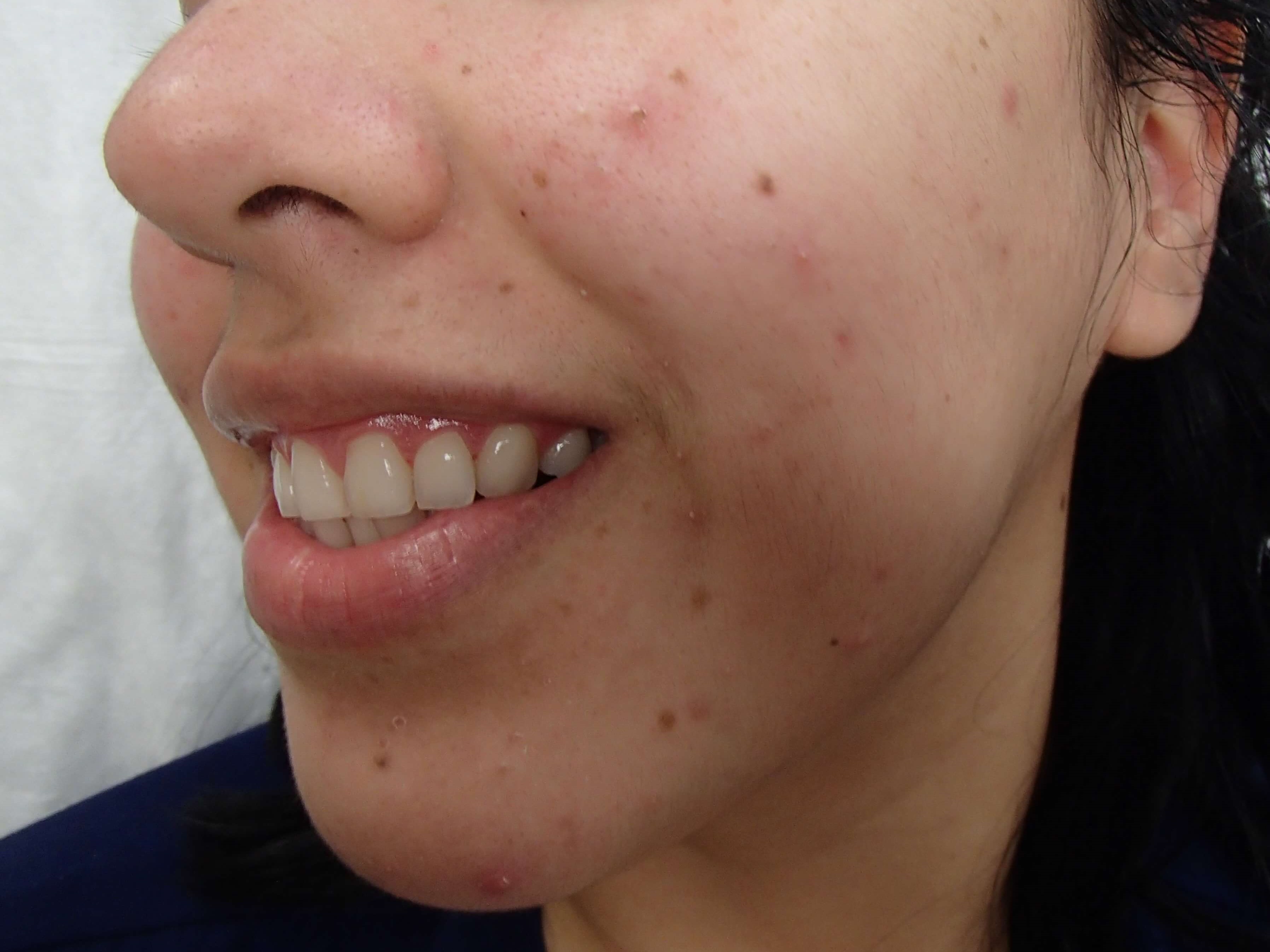 Timeless Dimple Before