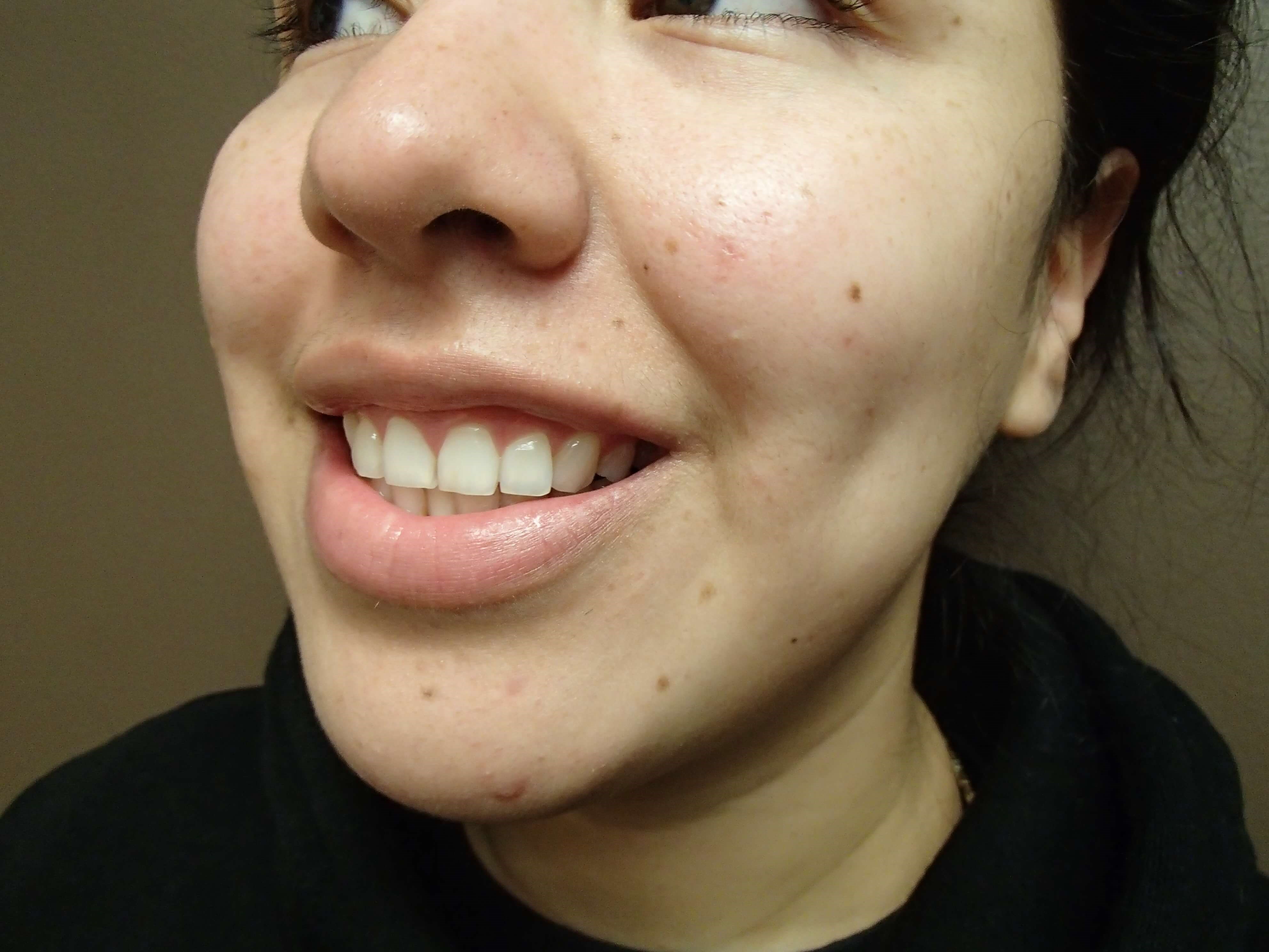Timeless Dimple After