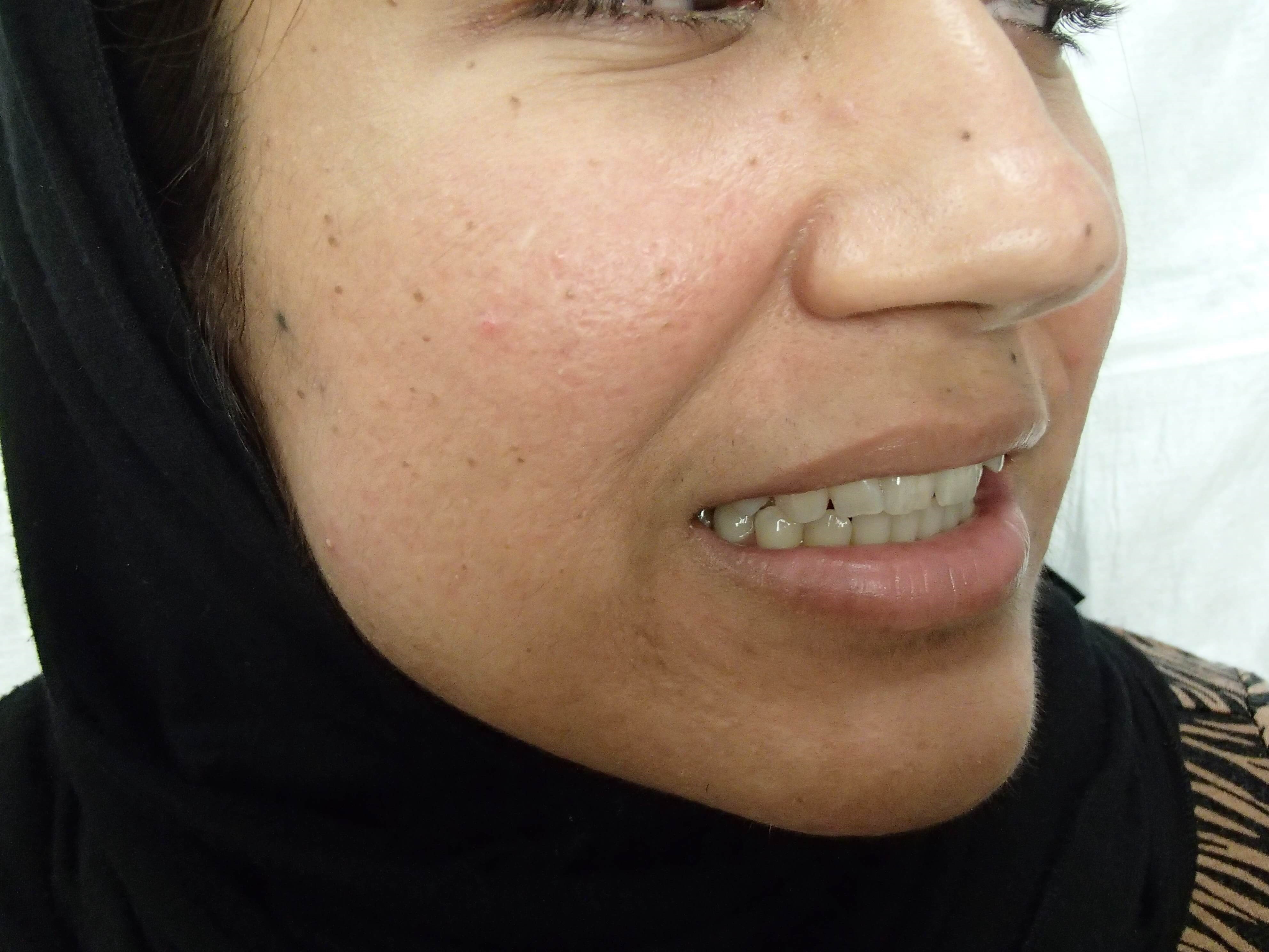 Timeless Dimple Before