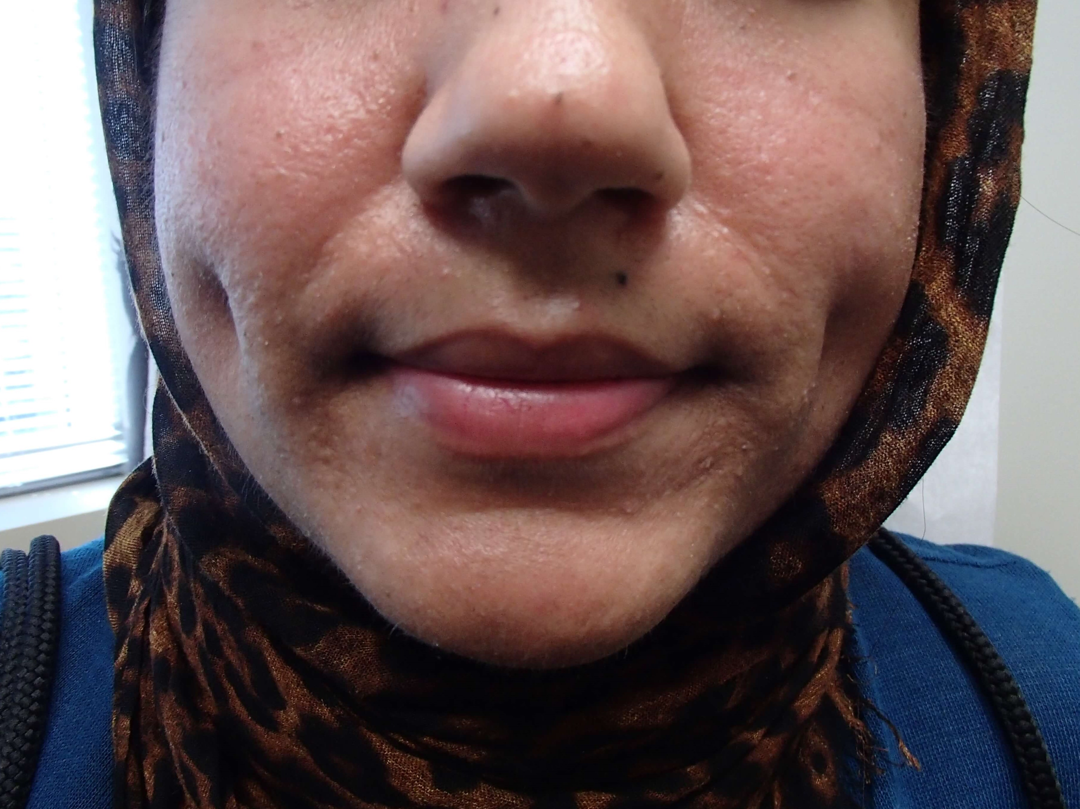 Timeless Dimple After