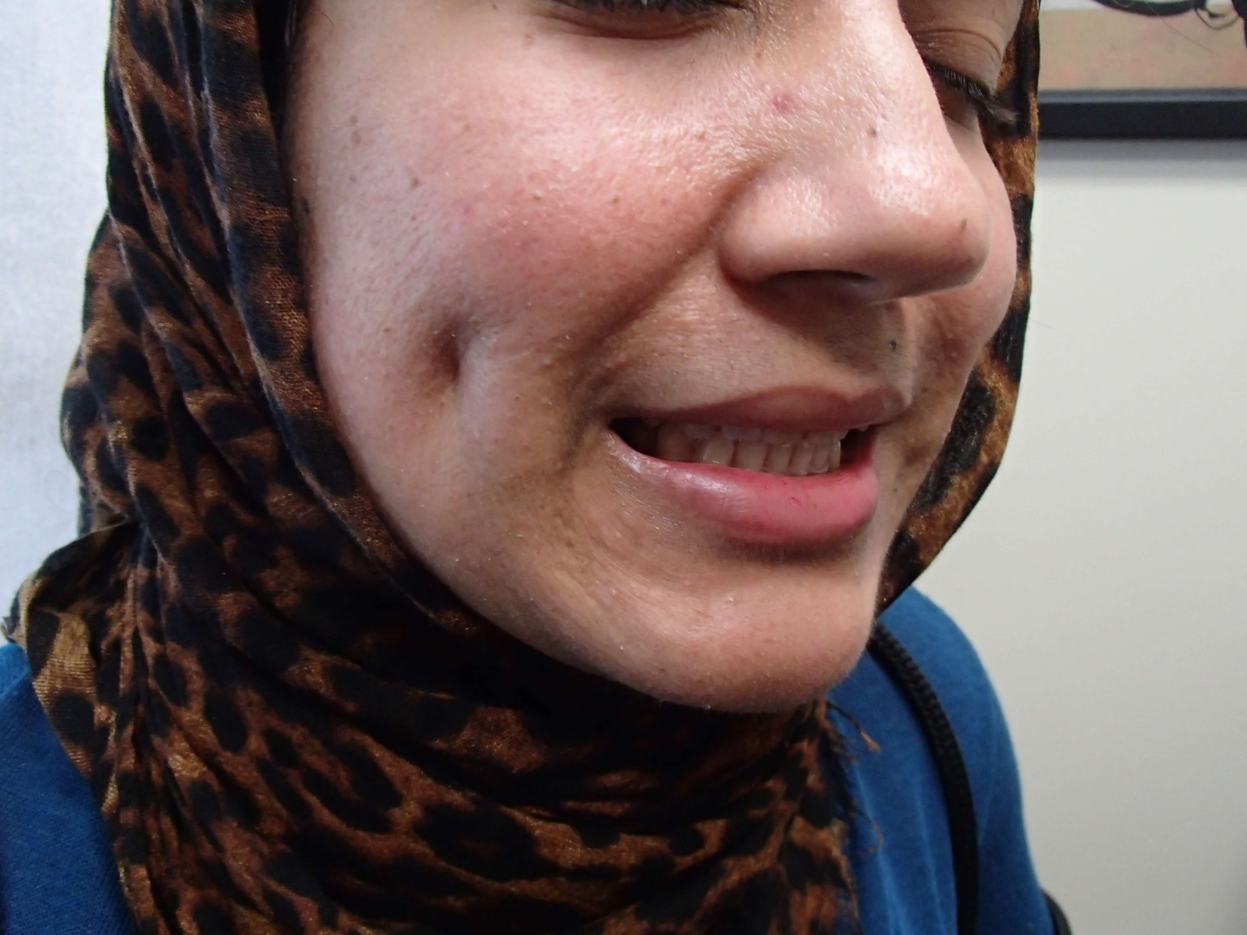 Timeless Dimple After