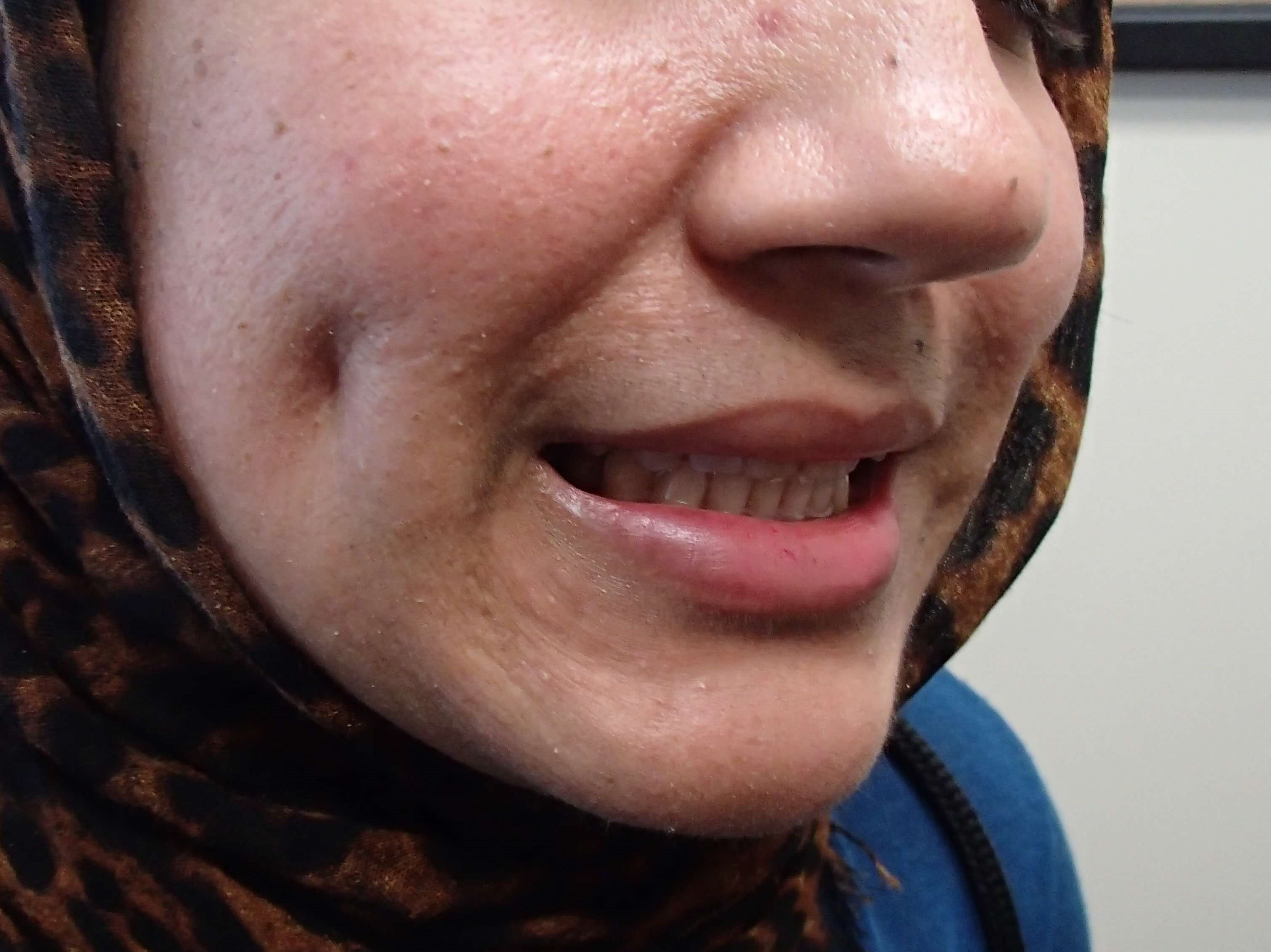 Timeless Dimple After