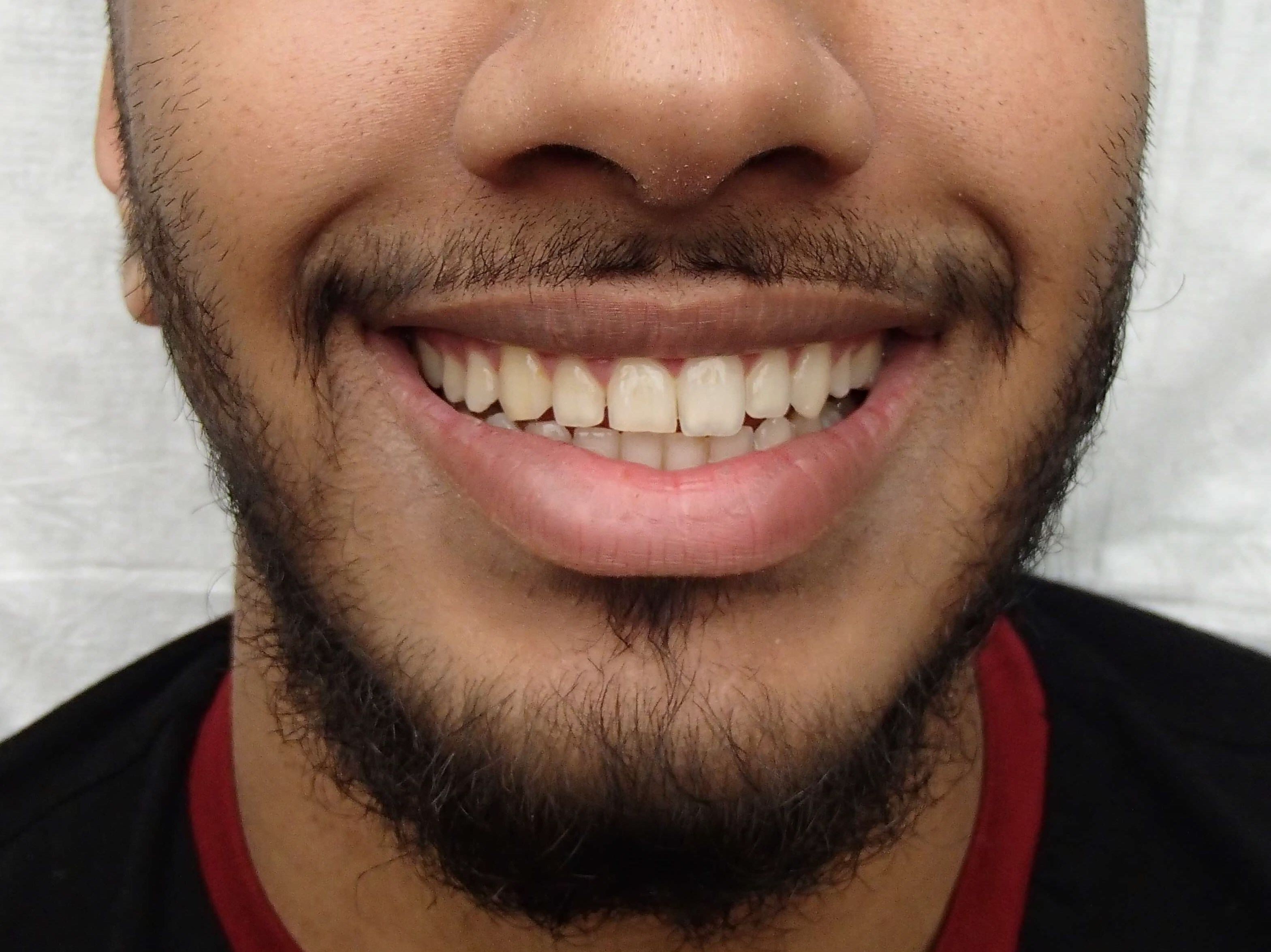 Timeless Dimple Before