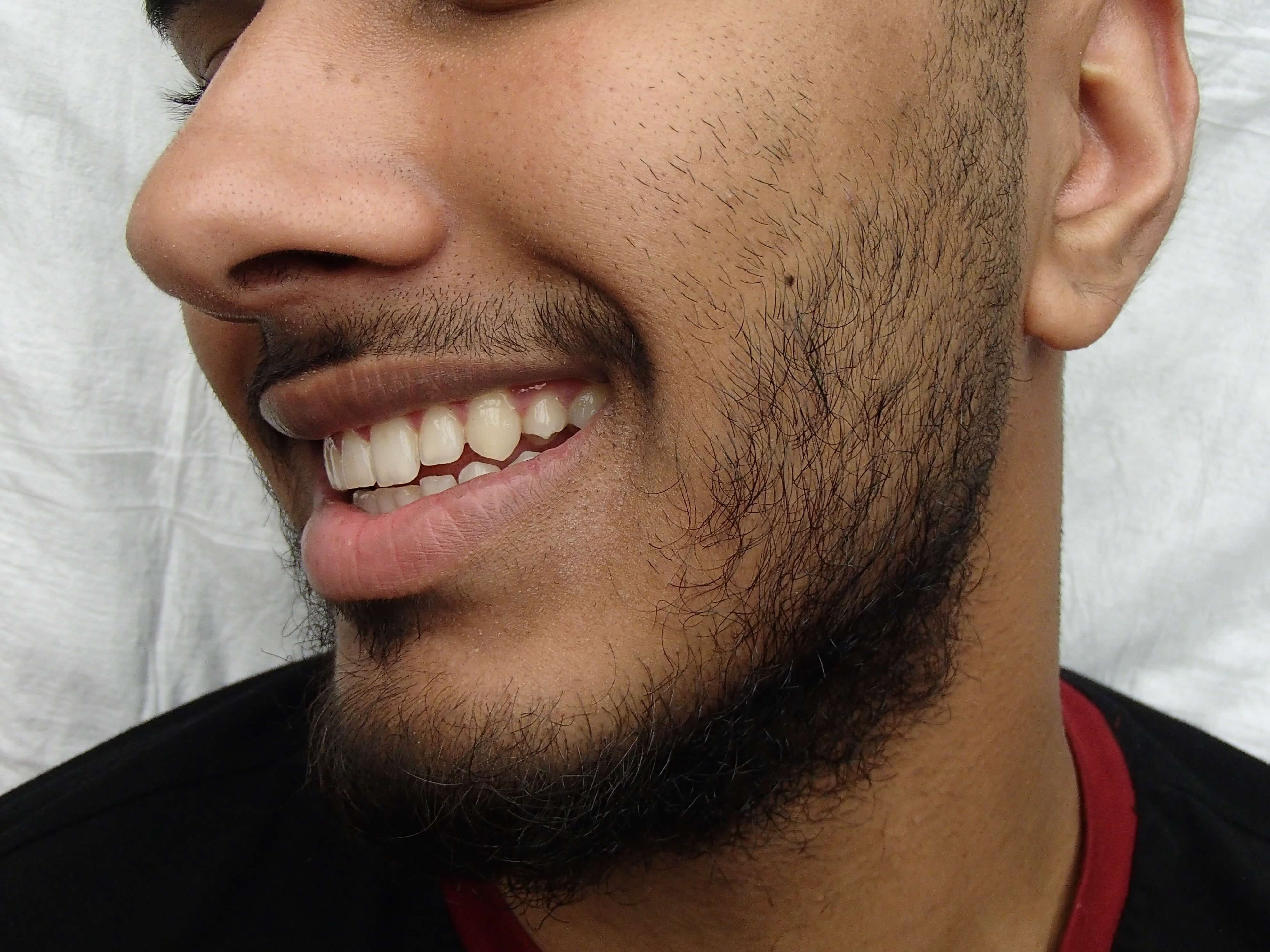 Timeless Dimple Before