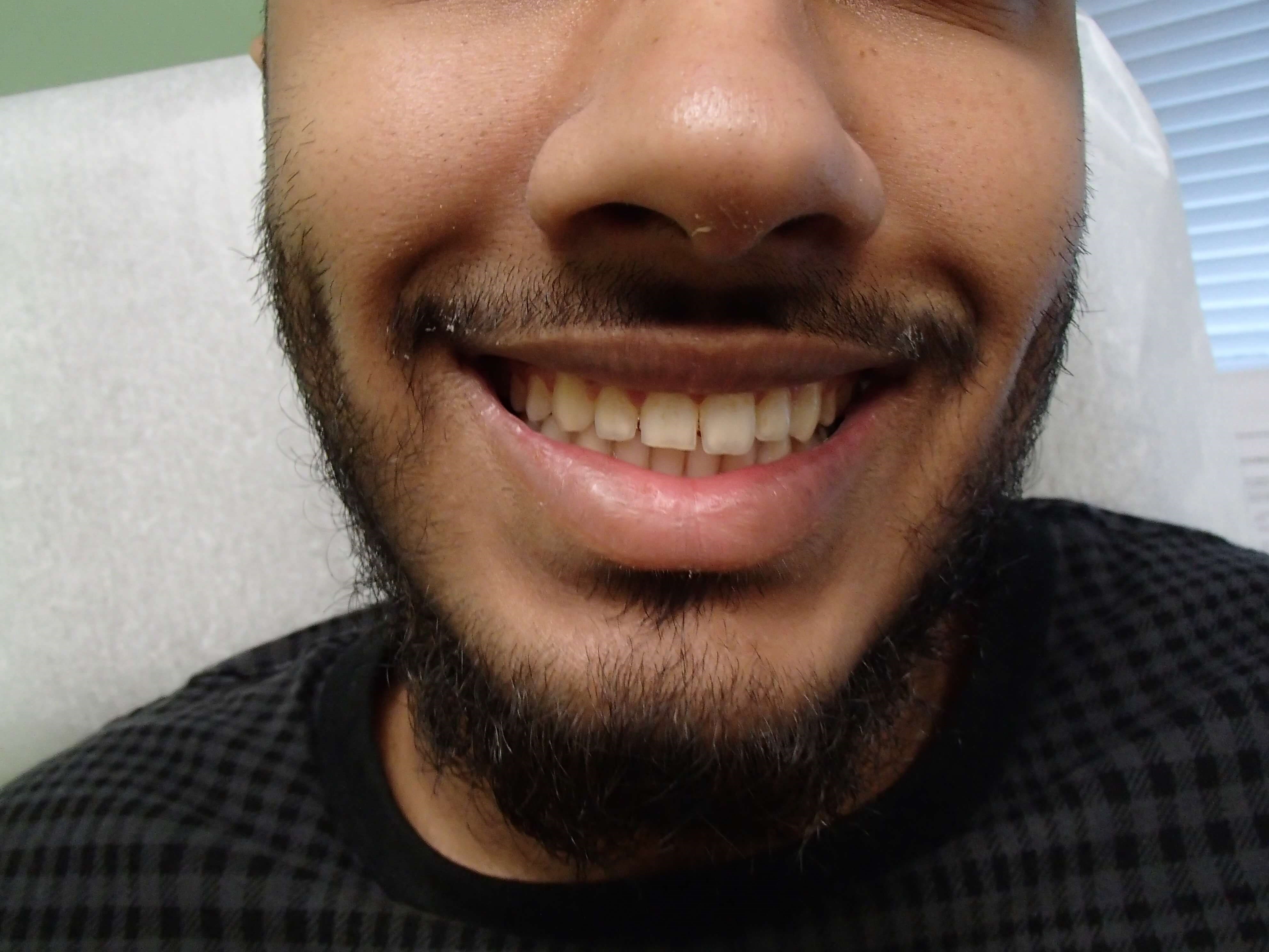 Timeless Dimple After