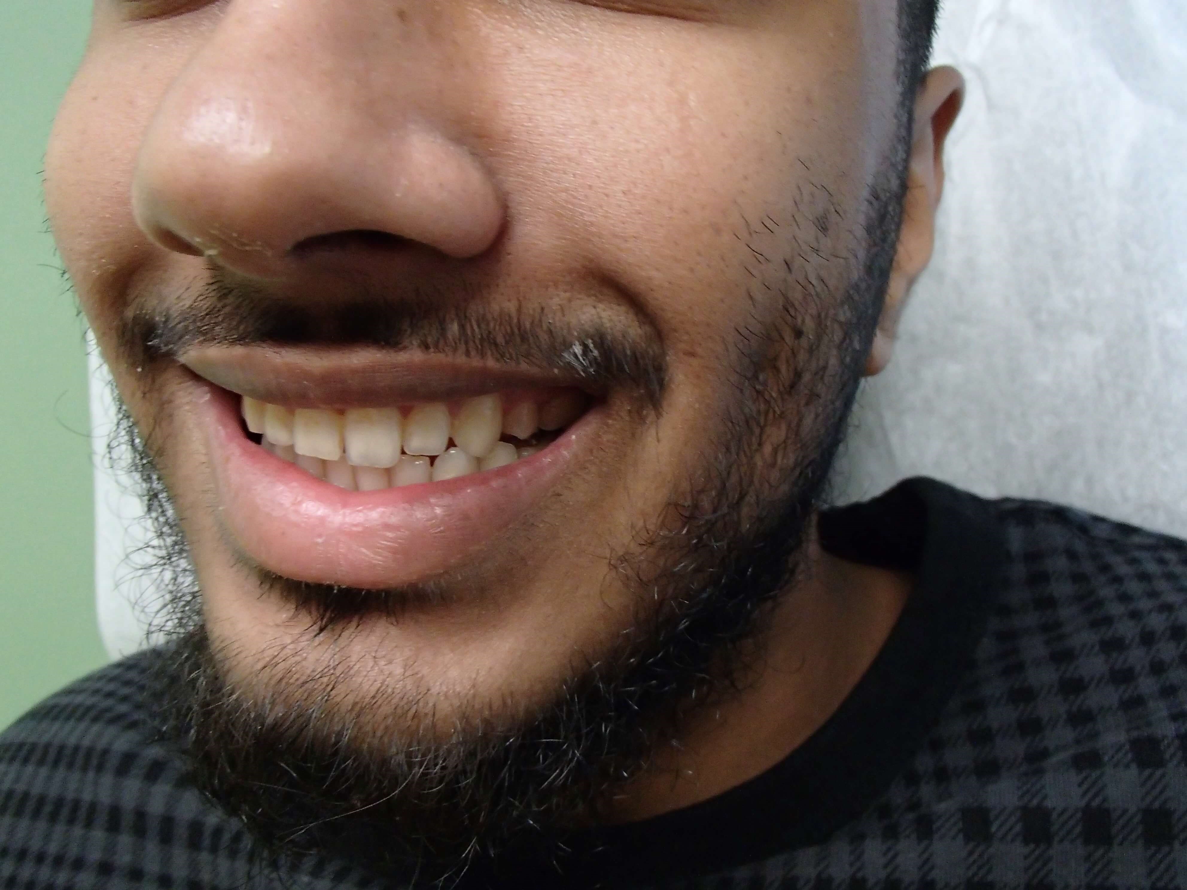 Timeless Dimple After