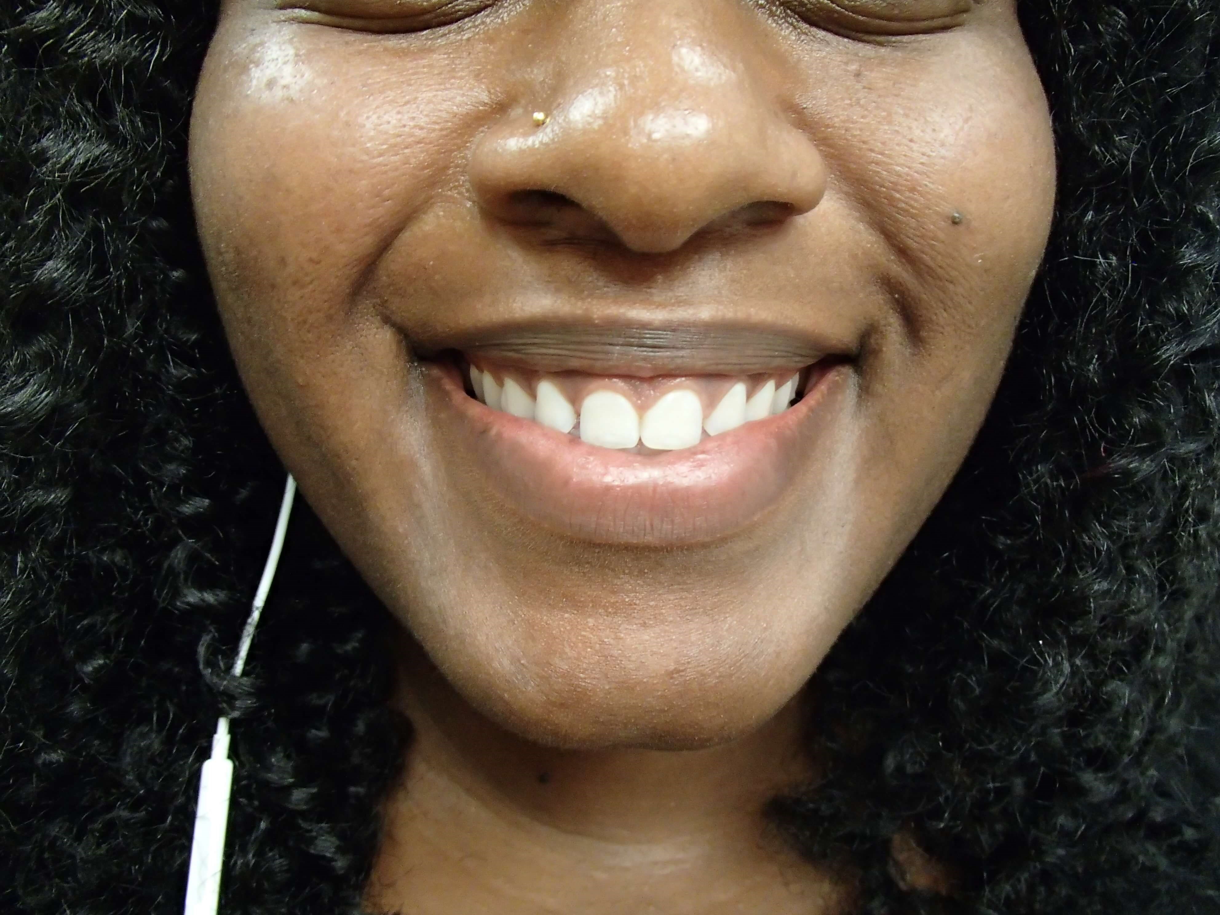 Timeless Dimple Before