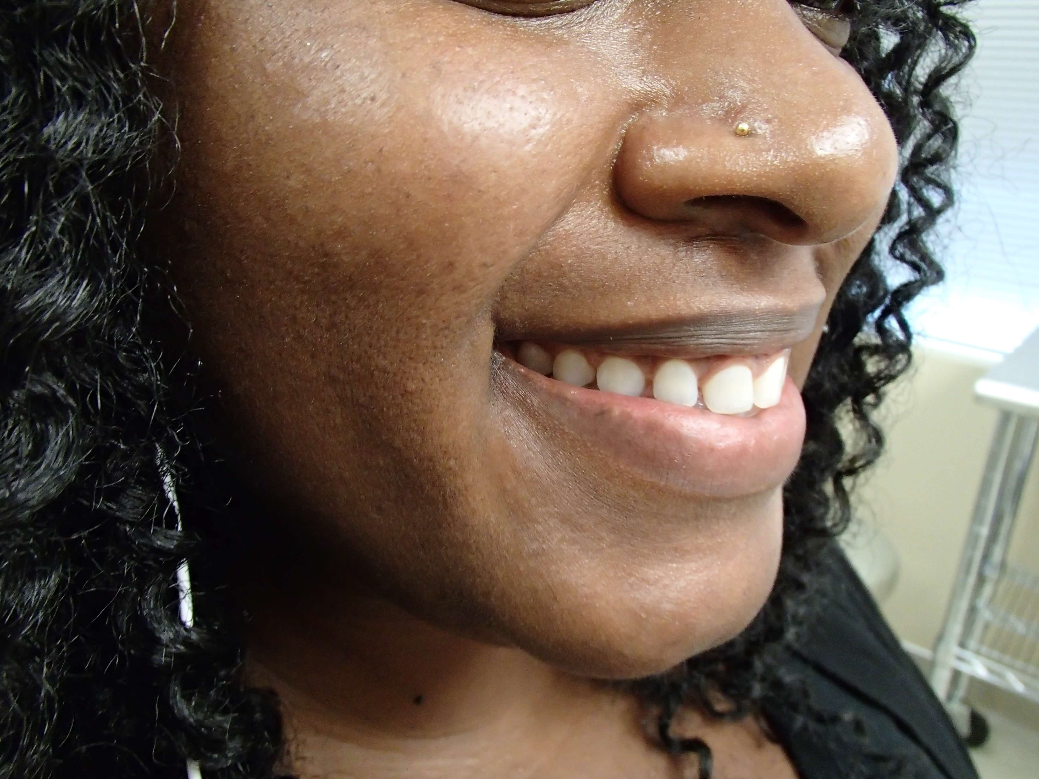 Timeless Dimple Before