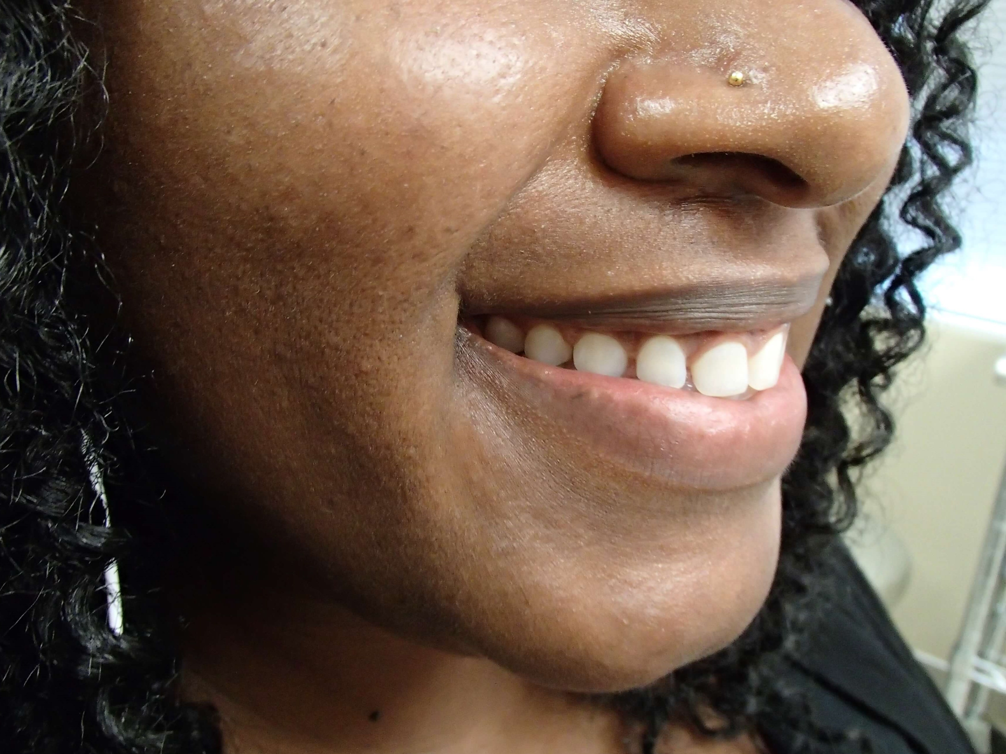 Timeless Dimple Before