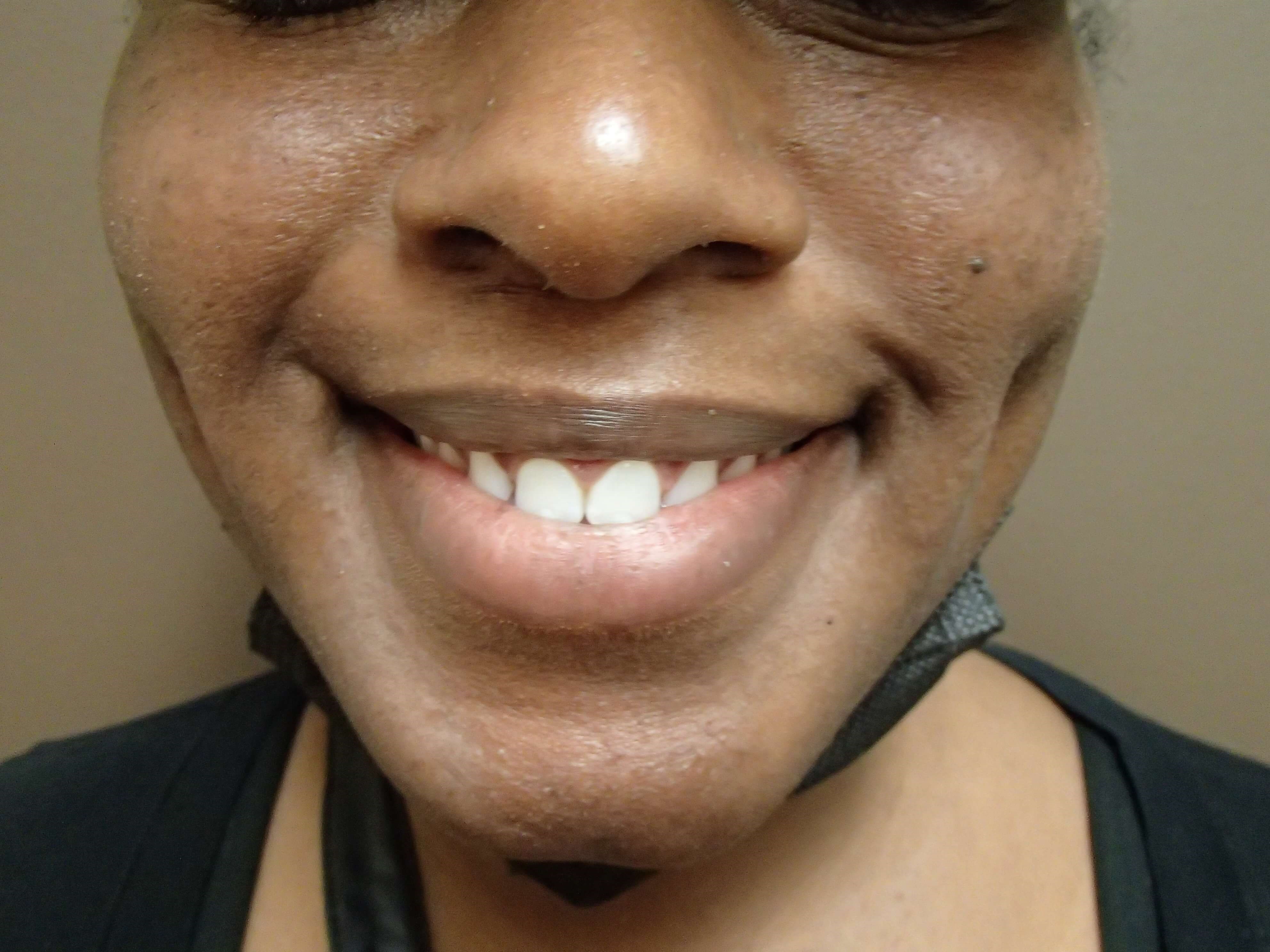 Timeless Dimple After