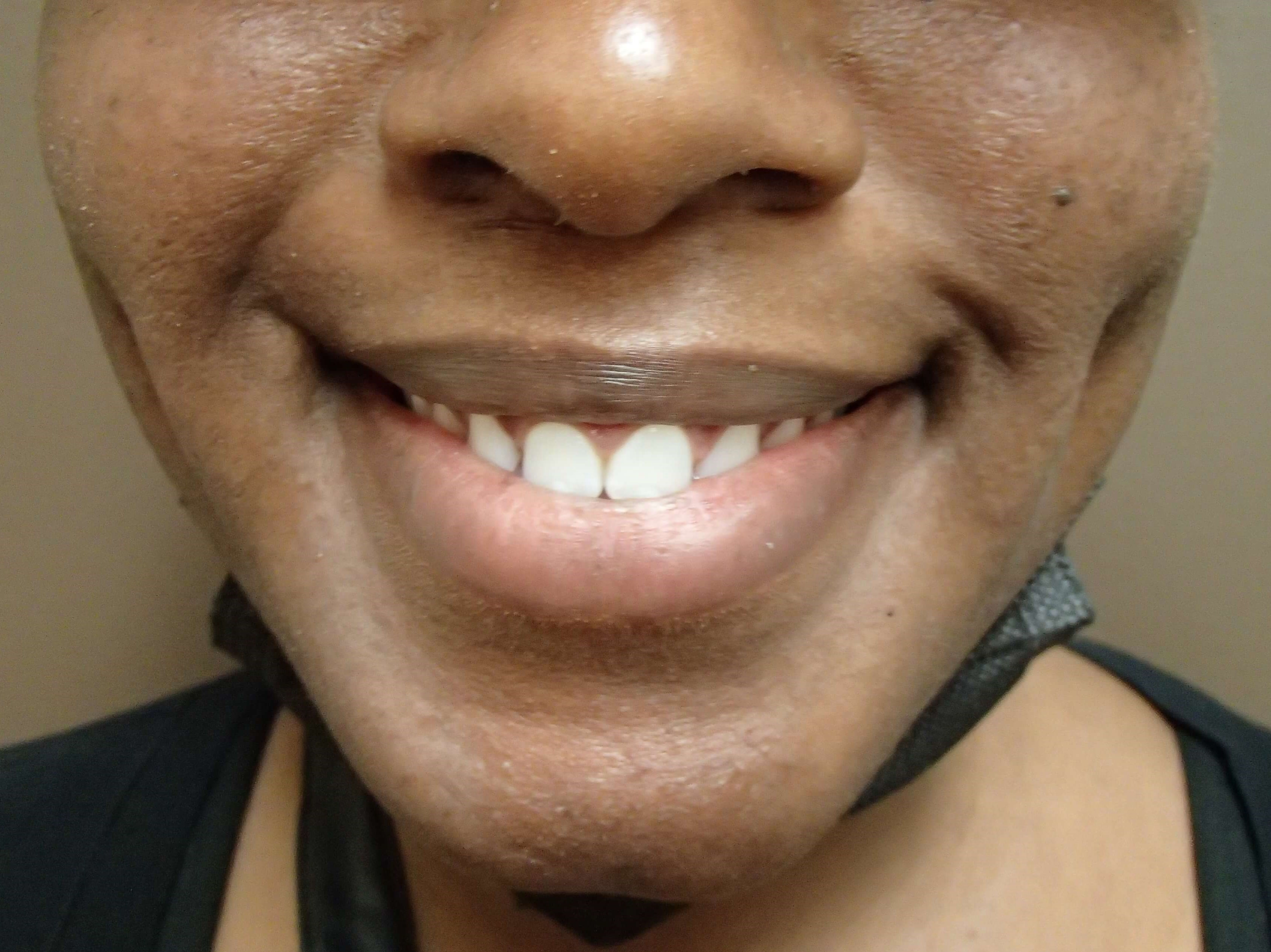 Timeless Dimple After