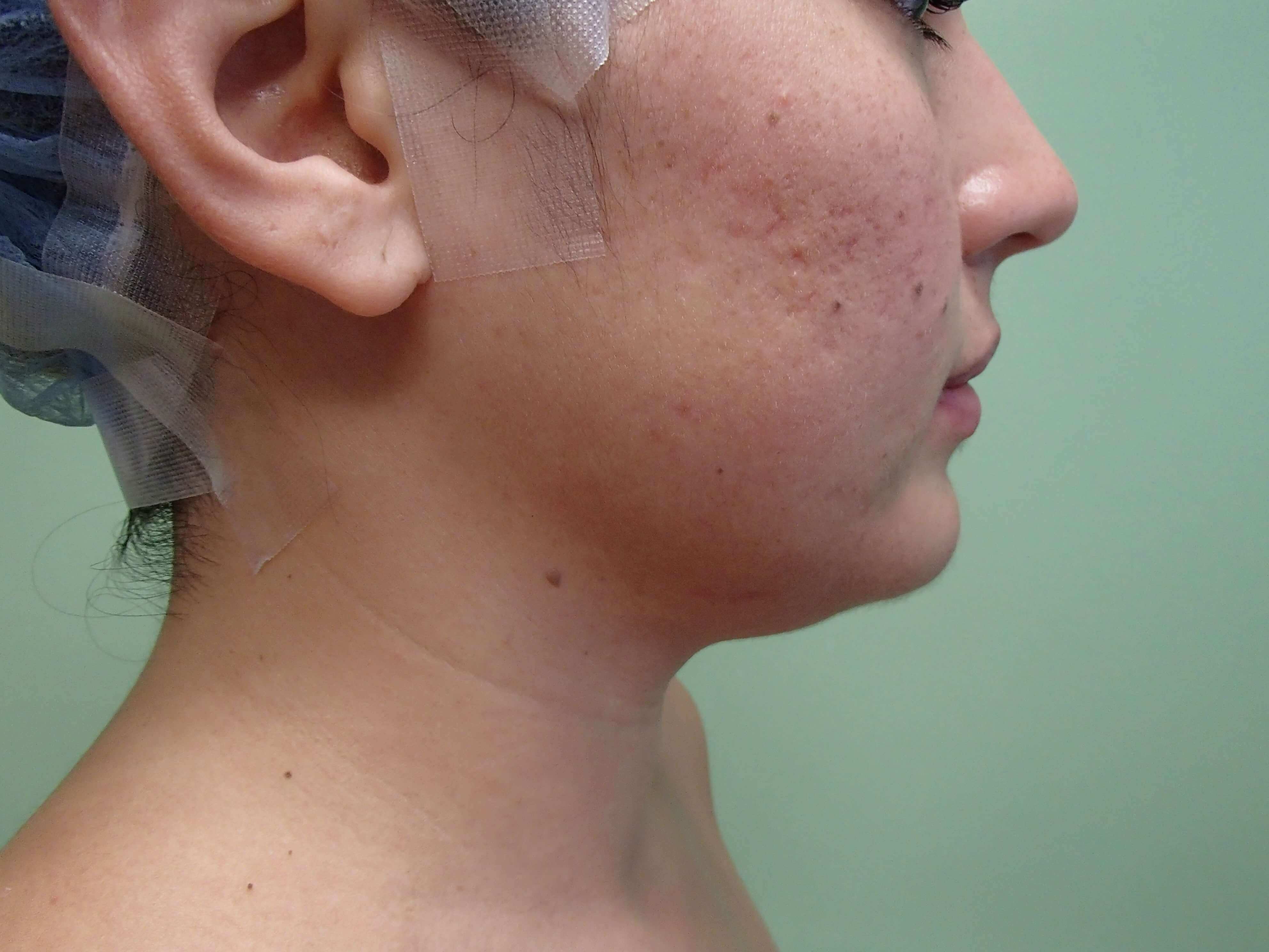 Liposuction Before