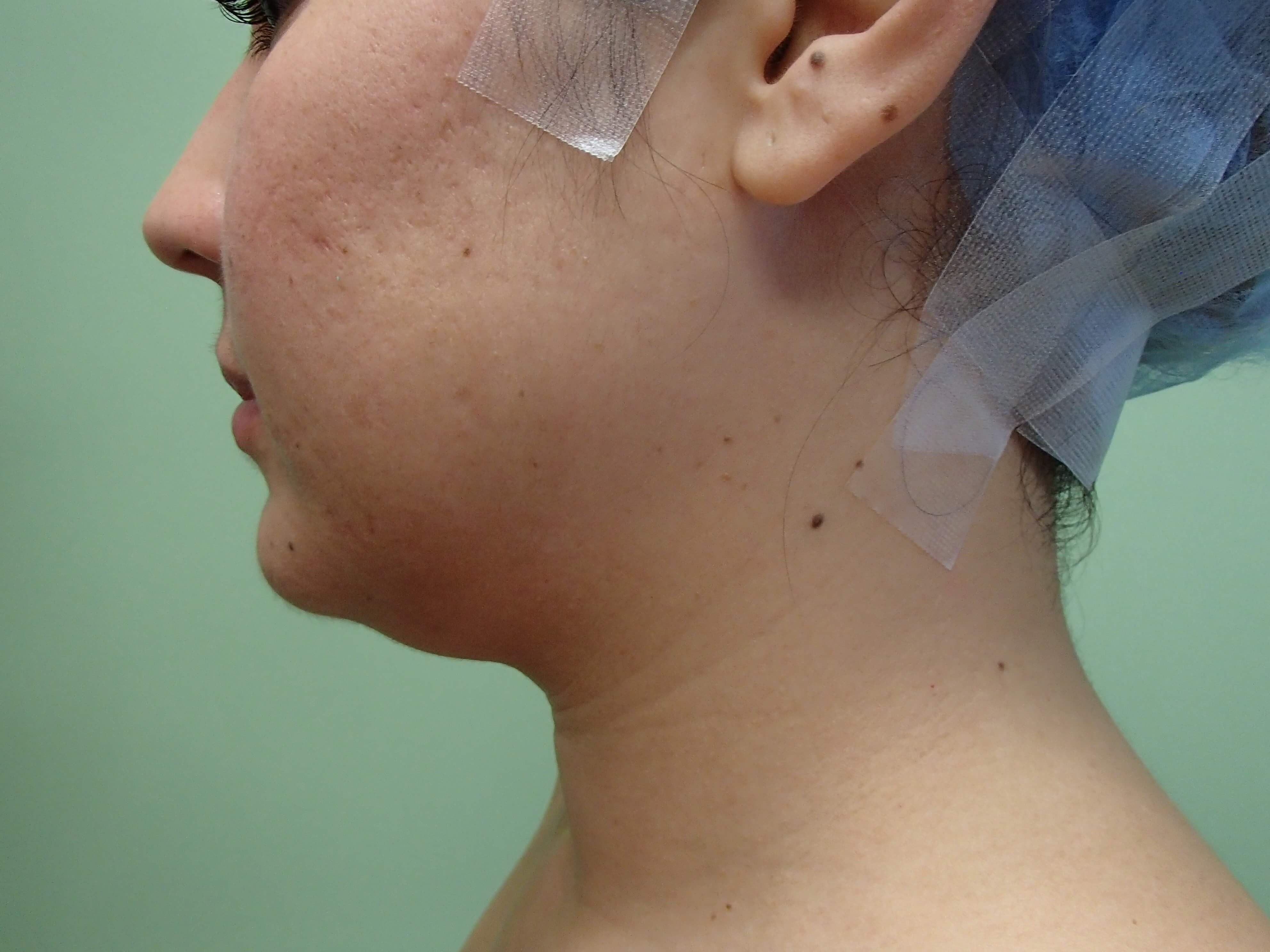 Liposuction Before