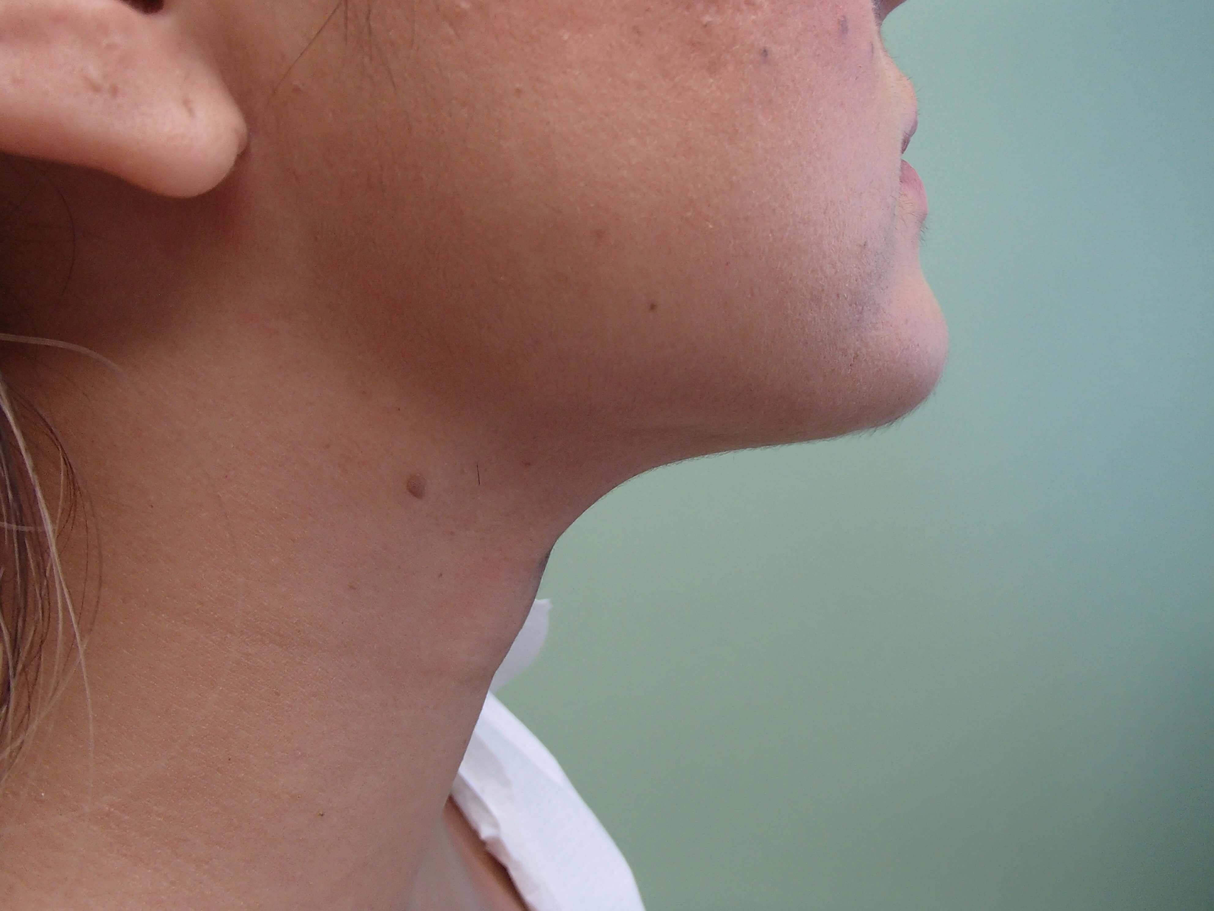 Liposuction After