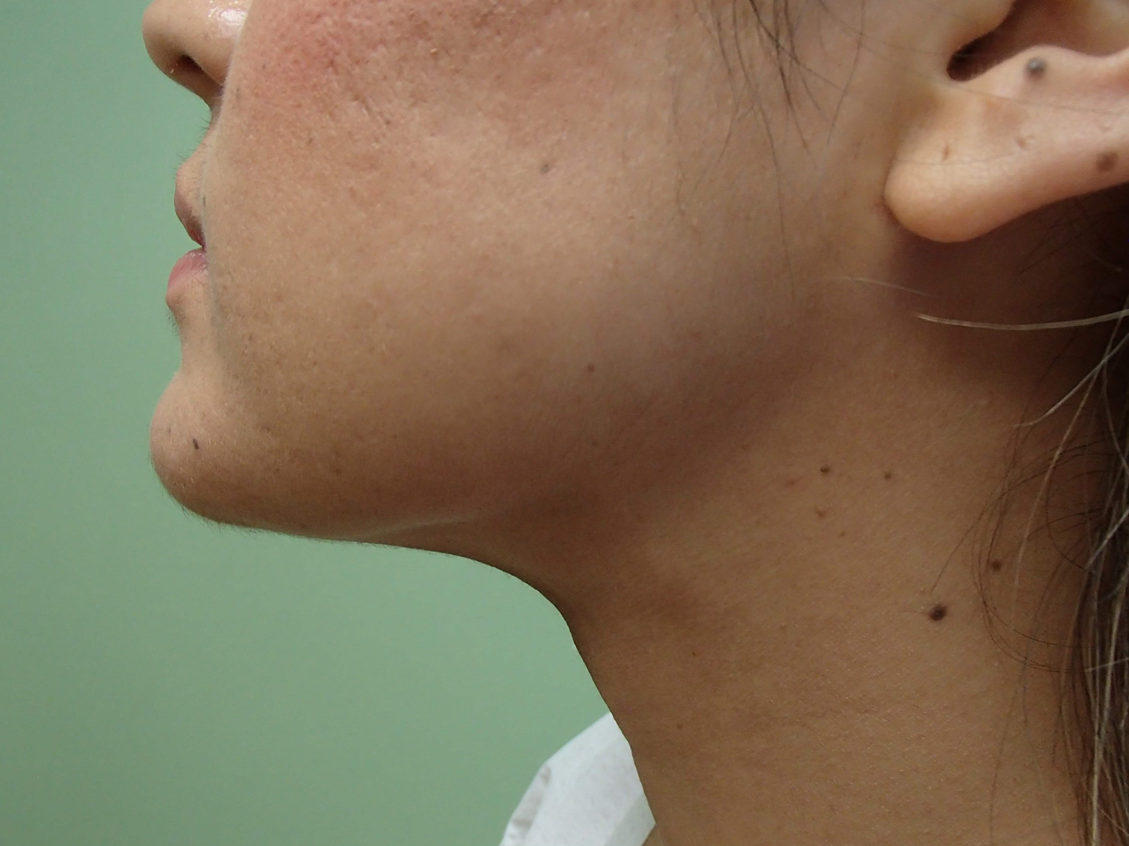 Liposuction After
