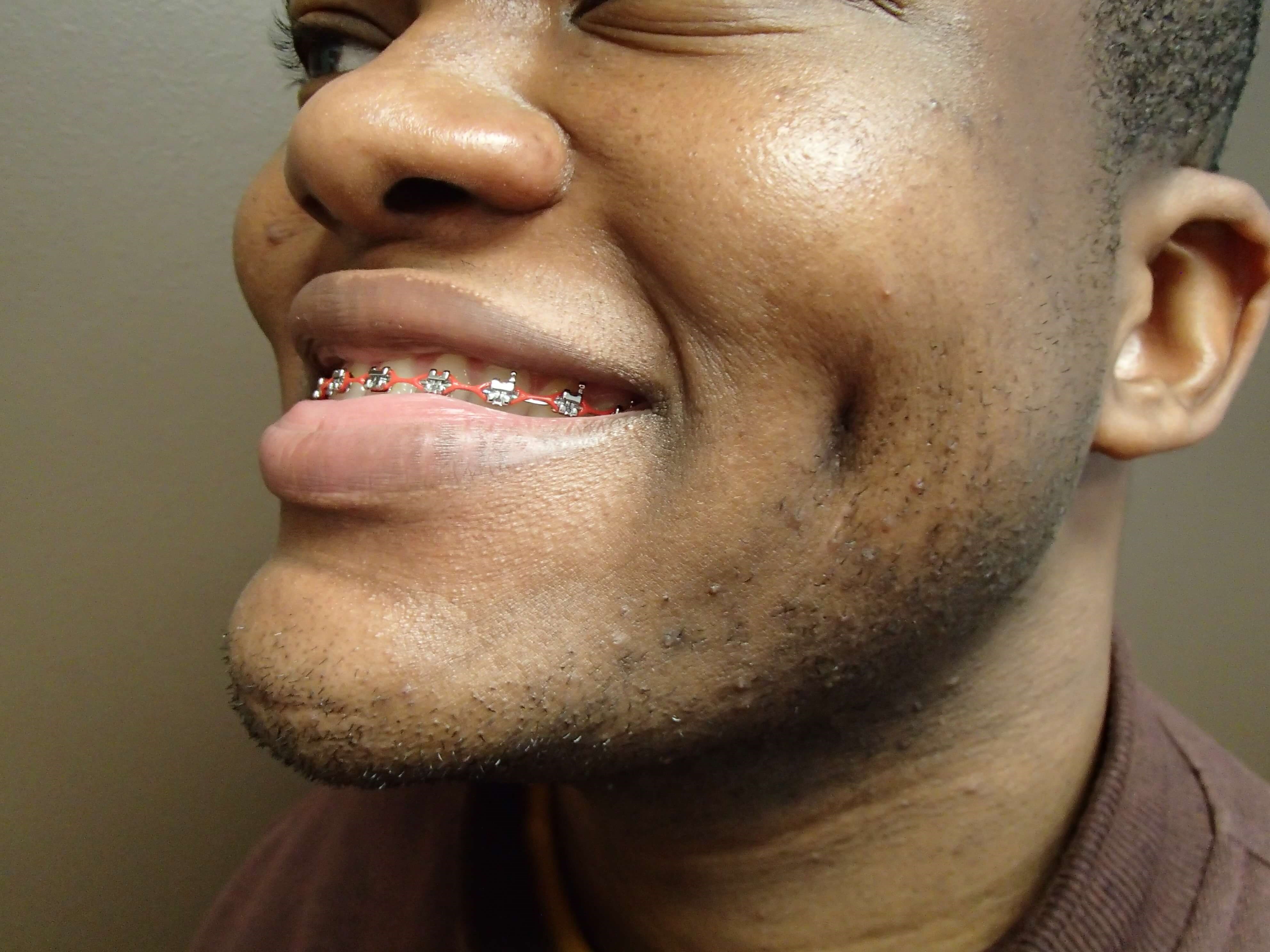 Timeless Dimple After