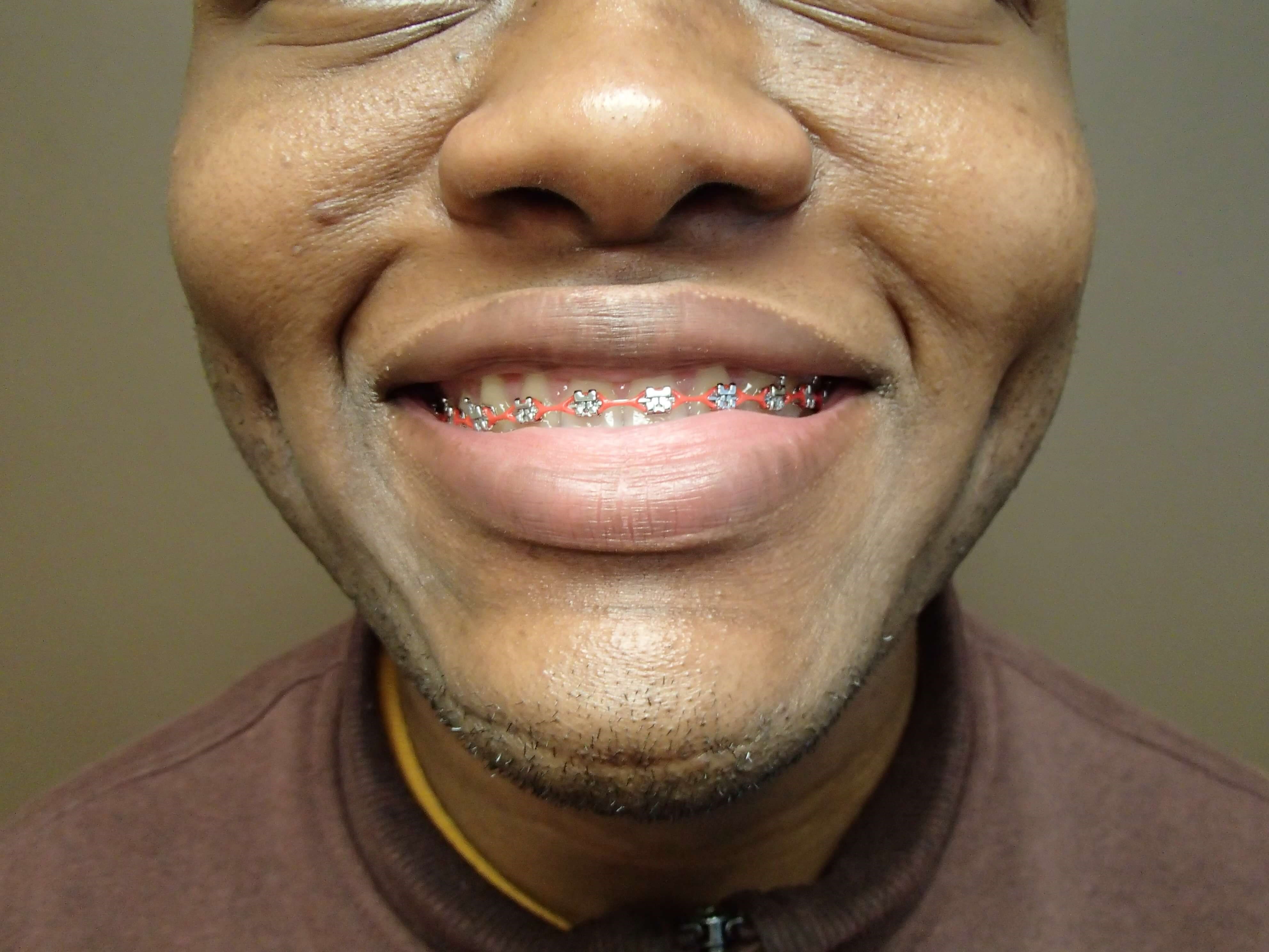 Timeless Dimple After