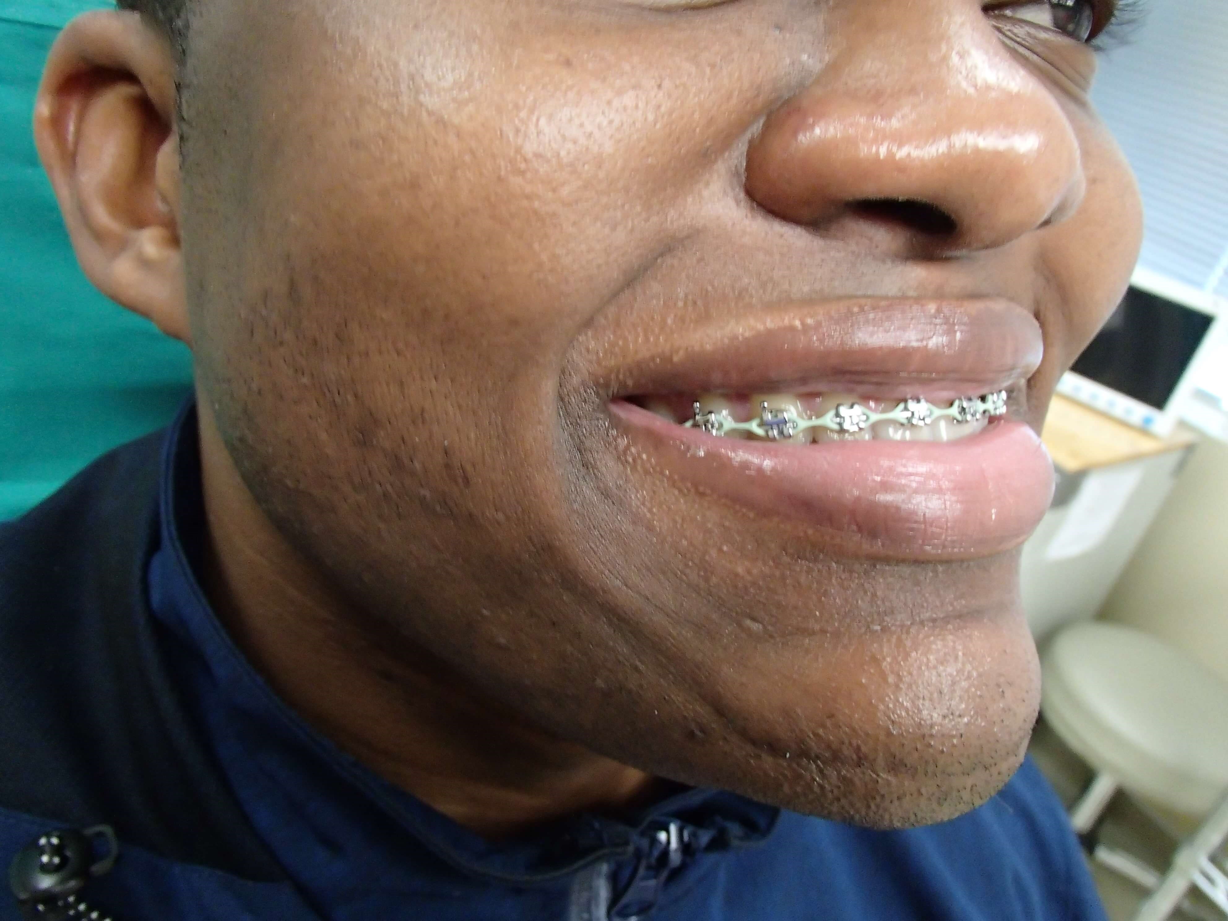 Timeless Dimple Before