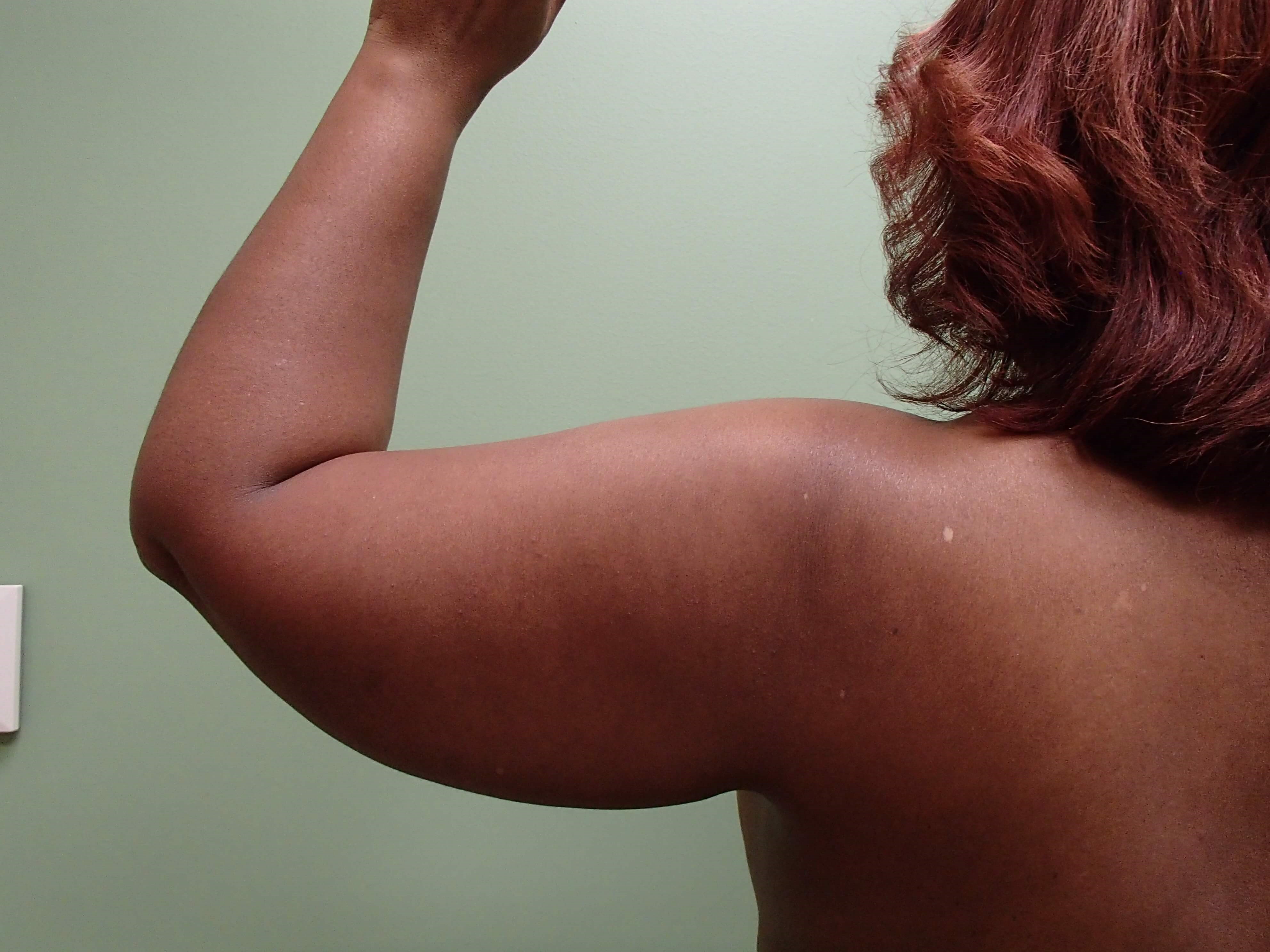 Liposuction Before