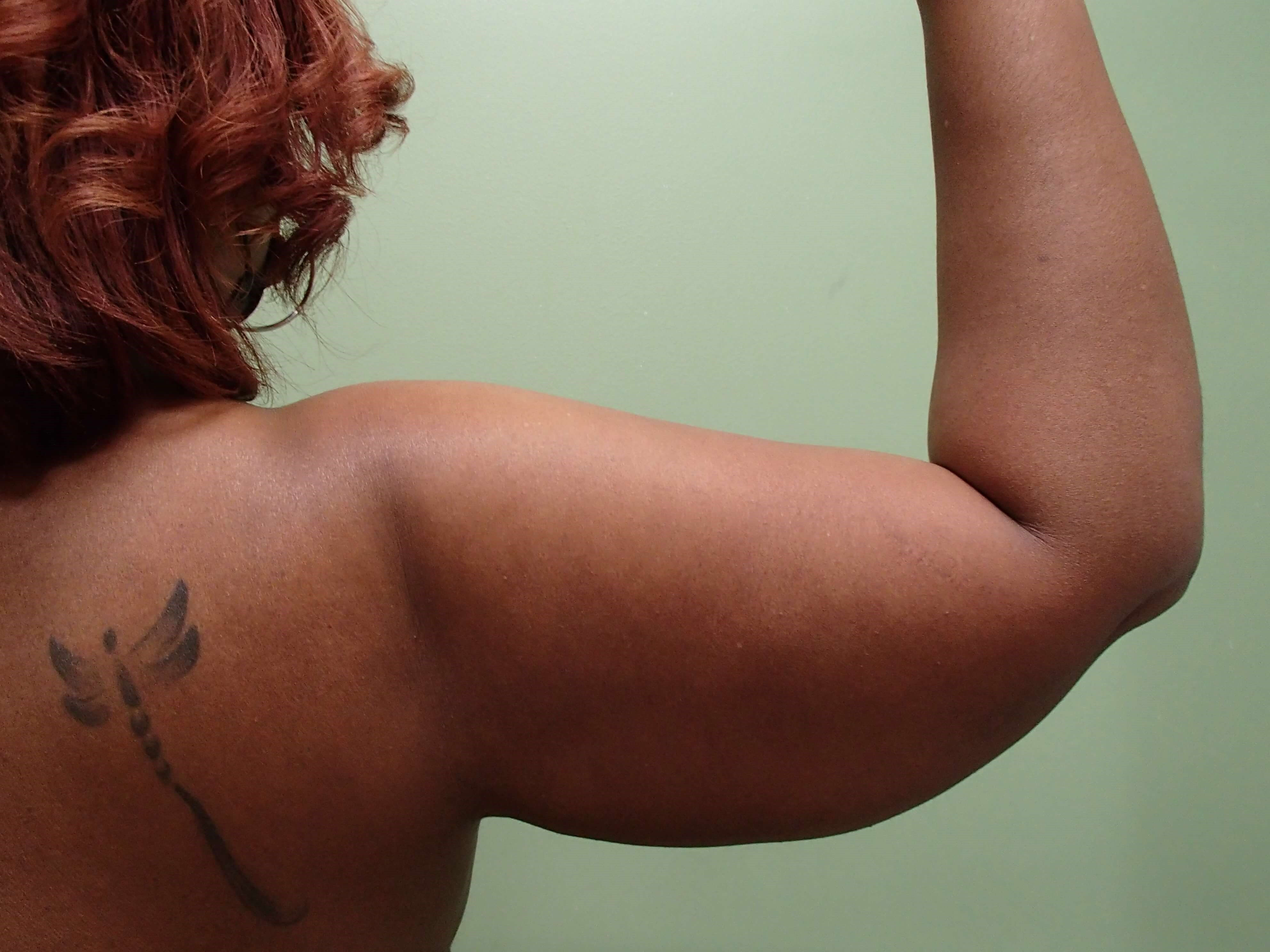 Liposuction Before