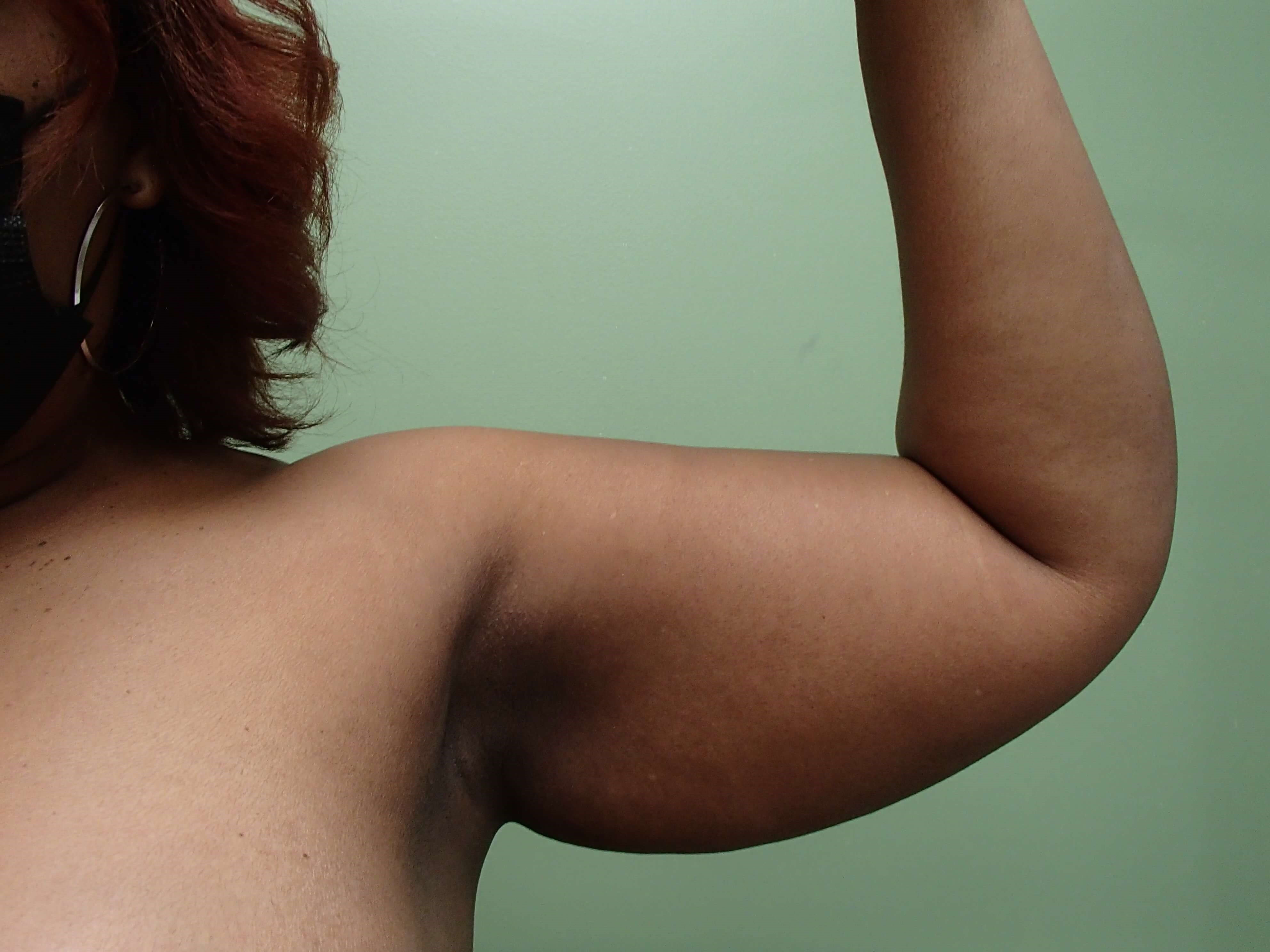Liposuction Before