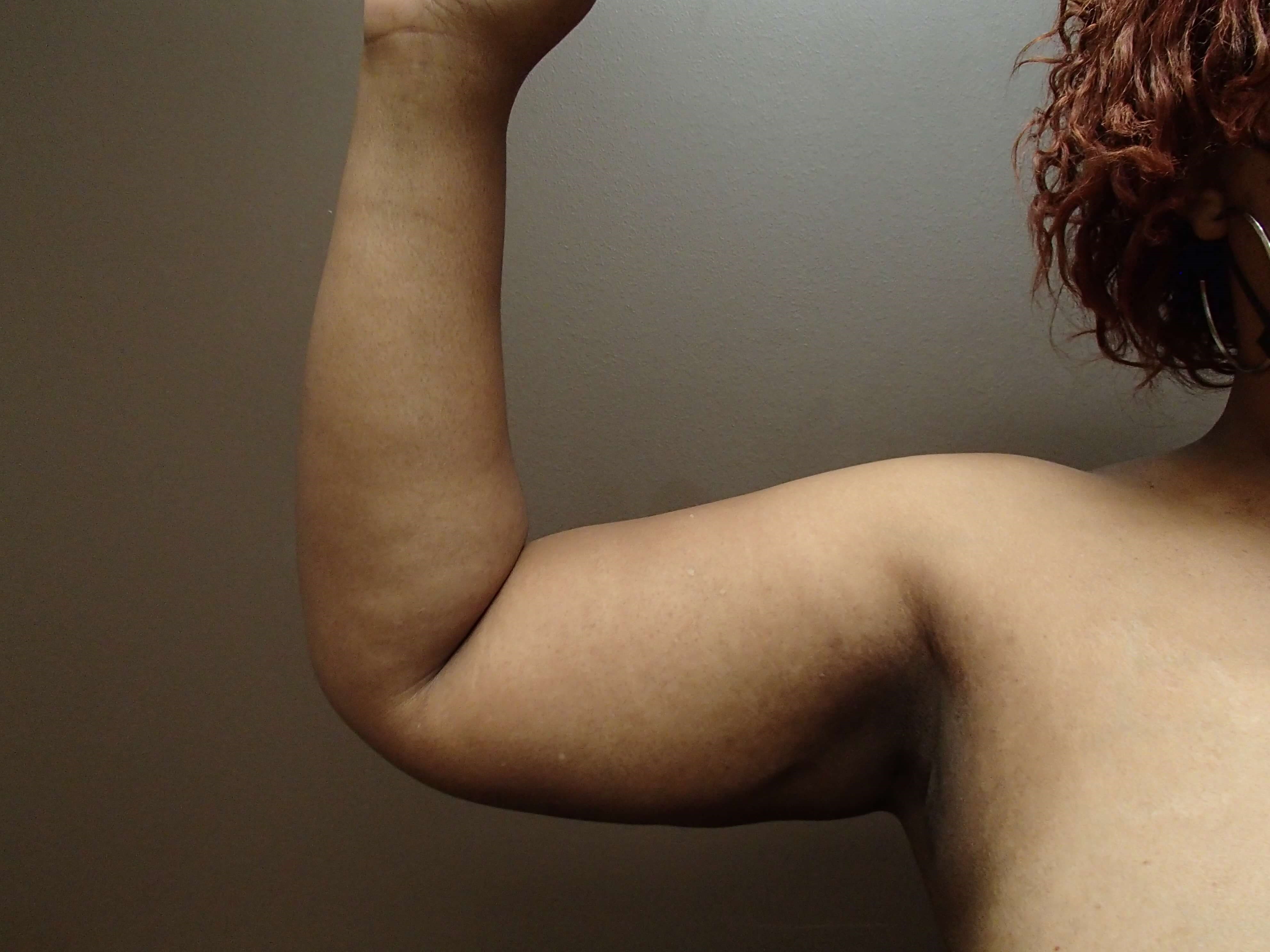 Liposuction After