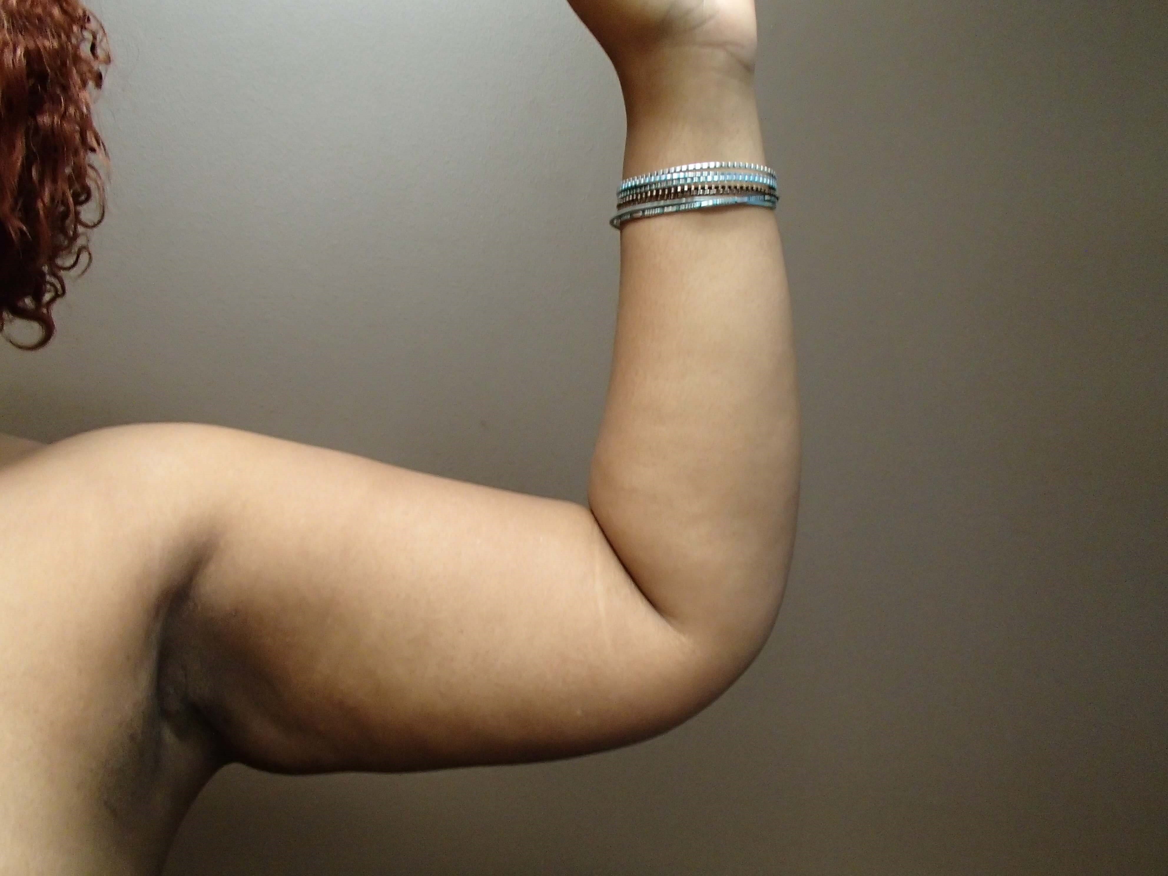 Liposuction After