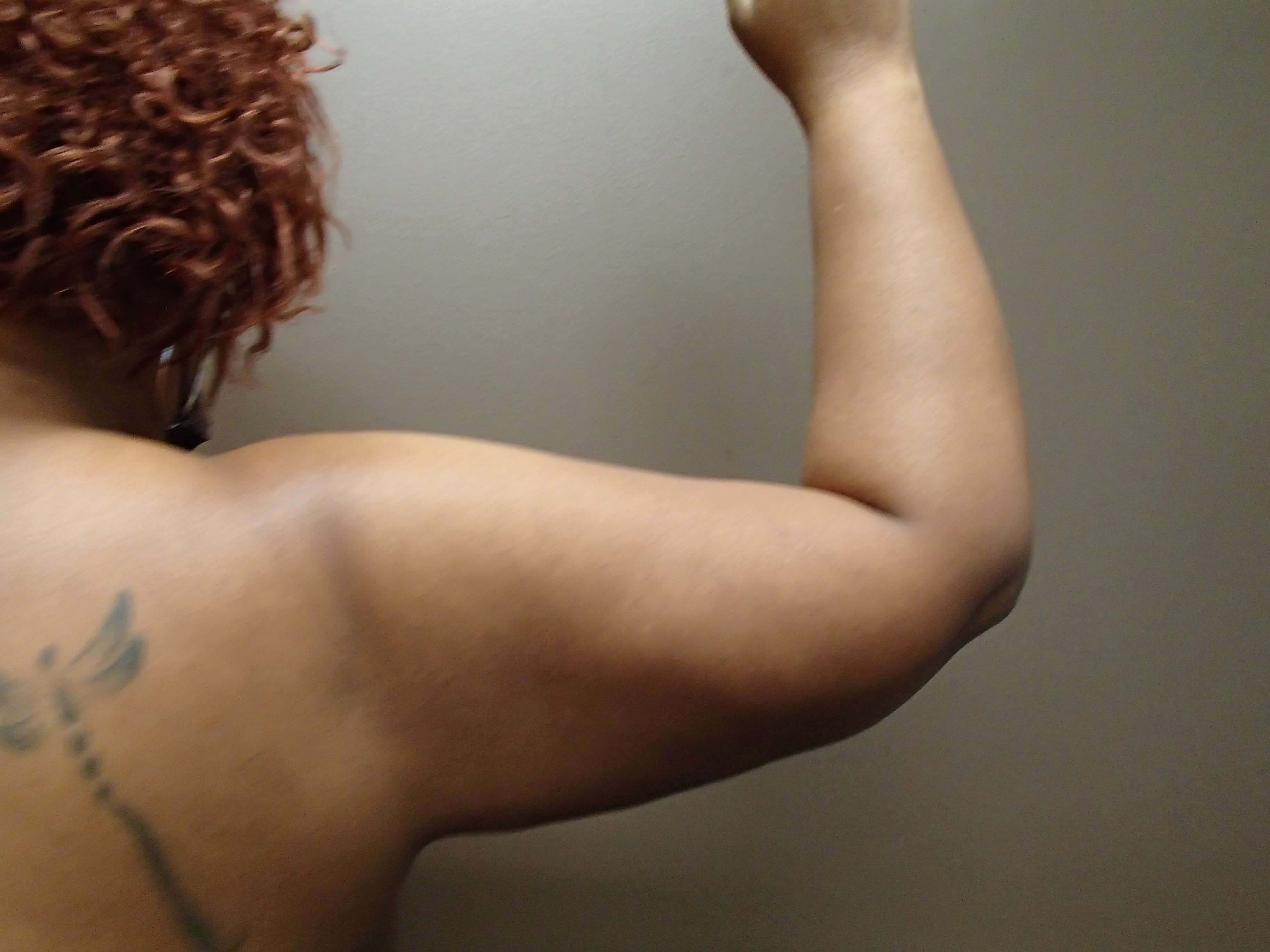 Liposuction After